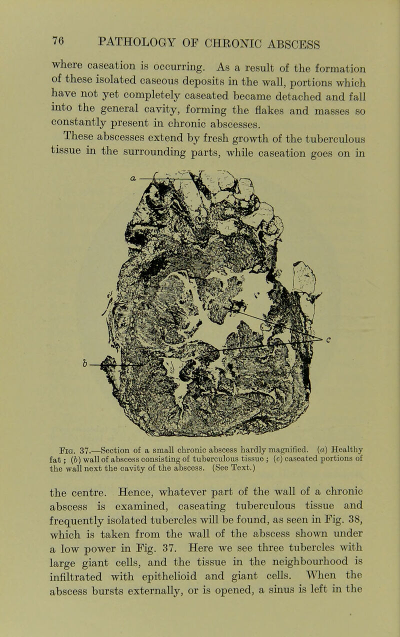where caseation is occurring. As a result of the formation of these isolated caseous deposits in the wall, portions which have not yet completely caseated became detached and fall into the general cavity, formmg the flakes and masses so constantly present in chronic abscesses. These abscesses extend by fresh growth of the tuberculous tissue in the surrounding parts, while caseation goes on in Fig. 37.—Section of a small chronic abscess hardly magnified, (a) Healthy fat; (&) wall of abscess consisting of tuberculous tissue ; (c) caseated portions of the wall next the cavity of the abscess. (See Text.) the centre. Hence, whatever part of the wall of a chronic abscess is examined, caseating tuberculous tissue and frequently isolated tubercles wUl be found, as seen in Fig. 38, which is taken from the wall of the abscess shown under a low power in Fig. 37. Here we see three tubercles with large giant cells, and the tissue in the neighbourhood is infiltrated with epithelioid and giant cells. When the abscess bursts externally, or is opened, a sinus is left in the
