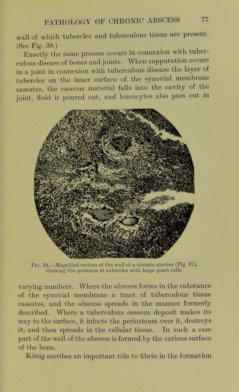 waU of which tubercles and tuberculous tissue are present. (See Fig. 39.) Exactly the same process occurs in connexion with tuber- culous disease of bones and joints. When suppuration occurs in a joint in connexion with tuberculous disease the layer of tubercles on the inner surface of the synovial membrane caseates, the caseous material falls into the cavity of the joint, fluid is poured out, and leucocytes also pass out in Fig. 38.—^Magnified section of the wall of a chronic abscess (Fig. 37), showing the presence of tubercles with large giant cells, varying numbers. Wliere the abscess forms in the substance of the synovial membrane a tract of tuberculous tissue caseates, and the abscess spreads in the manner formerly described. Where a tuberculous osseous deposit makes its way to the surface, it infects the periosteum over it, destroys it, and then spreads in the cellular tissue. In such a case part of the wall of the abscess is formed by the carious surface of the bone. Konig ascribes an important role to fibrin in the formation