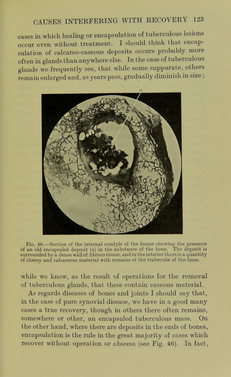 cases in which healmg or encapsulation of tuberculous lesions occur even without treatment. I should think that encap- sulation of calcareo-caseous deposits occurs probably more often in glands than anywhere else. In the case of tuberculous glands we frequently see, that while some suppurate, others remain enlarged and, as years pass, gradually diminish in size ; Fig. 46.—Section of the internal condyle of the femur showing the presence of an old encapsuled deposit (a) in the substance of the bone. The deposit is surrounded by a dense wall of fibrous tissue, and in the interior there is a quantity of cheesy and calcareous material with remains of the trabeculse of the bone. while we know, as the result of operations for the removal of tuberculous glands, that these contain caseous material. As regards diseases of bones and joints I should say that, in the case of pure synovial disease, we have in a good many cases a true recovery, though in others there often remains, somewhere or other, an encapsuled tuberculous mass. On the other hand, where there are deposits in the ends of bones, encapsulation is the rule in the great majority of cases which recover without operation or abscess (see Fig. 46). In fact.