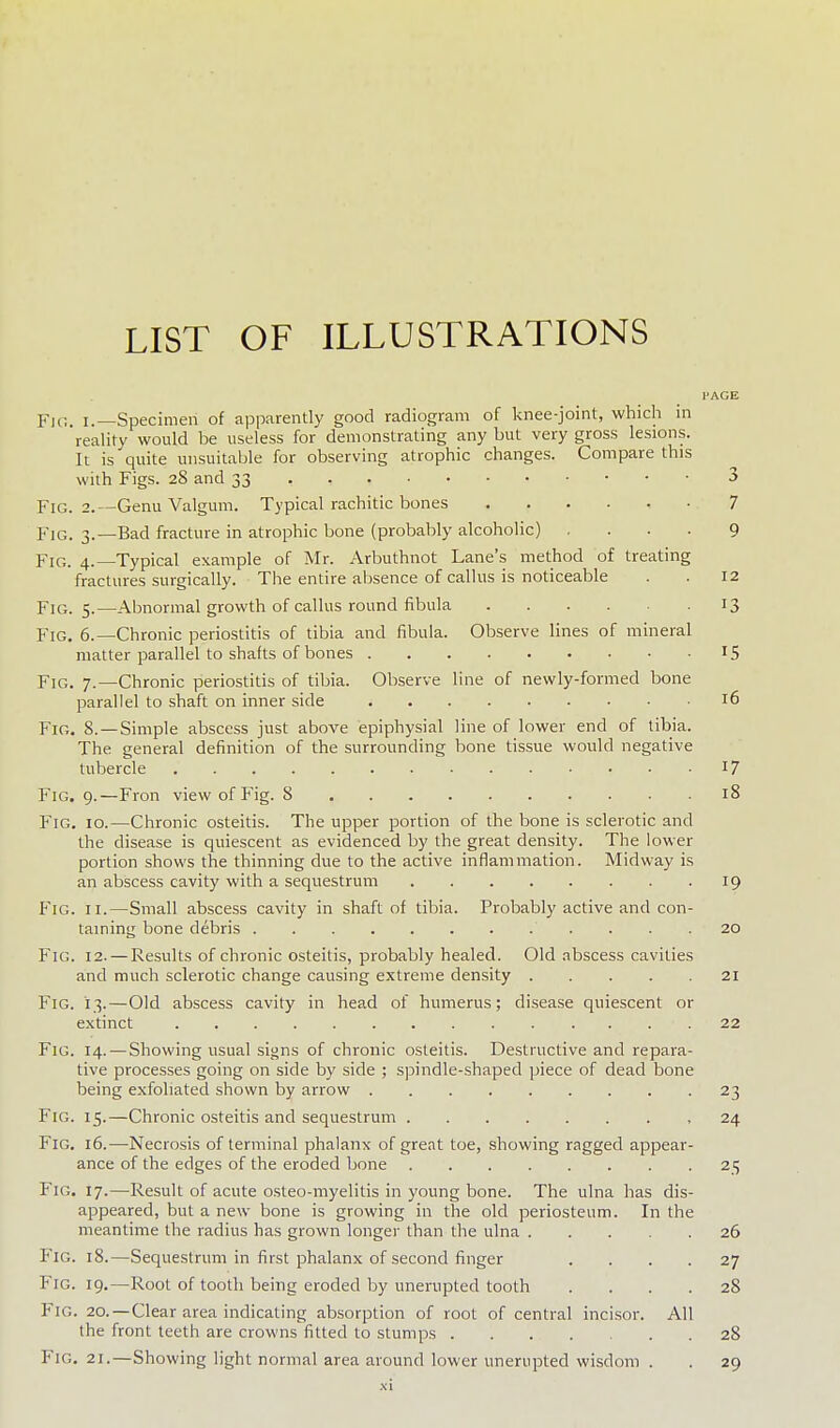 LIST OF ILLUSTRATIONS I'AGE Fi,;. I. Specimen of apparently good radiogram of knee-joint, which in reality would be useless for demonstrating any but very gross lesions. It is quite unsuitable for observing atrophic changes. Compare this with Figs. 28 and 33 3 Fig. 2.—Genu Valgum. Typical rachitic bones 7 Fig. 3.—Bad fracture in atrophic bone (probably alcoholic) .... 9 Fig. 4.—Typical example of Mr. Arbuthnot Lane's method of treating fractures surgically. The entire absence of callus is noticeable . . 12 Fig. 5.—Abnormal growth of callus round fibula 13 Fig. 6.—Chronic periostitis of tibia and fibula. Observe lines of mineral matter parallel to shafts of bones 15 Fig. 7.—Chronic periostitis of tibia. Observe line of newly-formed bone parallel to shaft on inner side 16 Fig. 8. —Simple abscess just above epiphysial line of lower end of tibia. The general definition of the surrounding bone tissue would negative tubercle 17 Fig. 9.—Fron view of Fig. 8 i8 Fig, 10.—Chronic osteitis. The upper portion of the bone is sclerotic and the disease is quiescent as evidenced by the great density. The lower portion shows the thinning due to the active inflammation. Midway is an abscess cavity with a sequestrum 19 Fig. II.—Small abscess cavity in shaft of tibia. Probably active and con- taining bone debris 20 Fig. 12. — Results of chronic osteitis, probably healed. Old abscess cavities and much sclerotic change causing extreme density 21 Fig. 13.—Old abscess cavity in head of humerus; disease quiescent or extinct 22 Fig. 14. —Showing usual signs of chronic osteitis. Destructive and repara- tive processes going on side by side ; spindle-shaped piece of dead bone being exfoliated shown by arrow . . . 23 Fig. 15.—Chronic osteitis and sequestrum 24 Fig, 16.—Necrosis of terminal phalanx of great toe, showing ragged appear- ance of the edges of the eroded bone 2 ; Fig, 17.—Result of acute osteo-myelitis in young bone. The ulna has dis- appeared, but a new bone is growing in the old periosteum. In the meantime the radius has grown longer than the ulna 26 Fig. 18.—Sequestrum in first phalanx of second finger .... 27 Fig. 19,—Root of tooth being eroded by unerupted tooth .... 28 Fig. 20.—Clear area indicating absorption of root of central incisor. All the front teeth are crowns fitted to stumps 28 Fig, 21.—Showing light normal area around lower unerupted wisdom . . 29