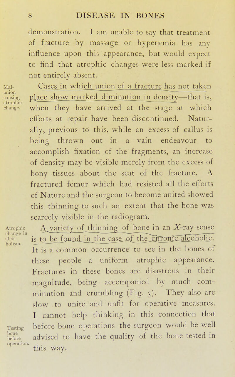 Mal- union causing atrophic change. Alropliic change in alco- holism. Testing bone before operation. demonstration. I am unable to say that treatment of fracture by massage or hyperasmia has any influence upon this appearance, but would expect to find that atrophic changes were less marked if not entirely absent. Cases in which jjnion^of a fracturejias not taken place show marked diminution indensity—that is, when they have arrived at the stage at which efforts at repair have been discontinued. Natur- ally, previous to this, while an excess of callus is being thrown out in a vain endeavour to accomplish fixation of the fragments, an increase of density may be visible merely from the excess of bony tissues about the seat of the fracture. A fractured femur which had resisted all the efforts of Nature and the surgeon to become united showed this thinning to such an extent that the bone was scarcely visible in the radiogram. A^v^ri£ty_of_th^^ in an X-ray sense is t£_b£j9uadJii__die_ca^^ It is a common occurrence to see in the bones of these people a uniform atrophic appearance. Fractures in these bones are disastrous in their magnitude, being accompanied by much com- minution and crumbling (Fig. 3). They also are slow to unite and unfit for operative measures. I cannot help thinking in this connection that before bone operations the surgeon would be well advised to have the quality of the bone tested in this way.