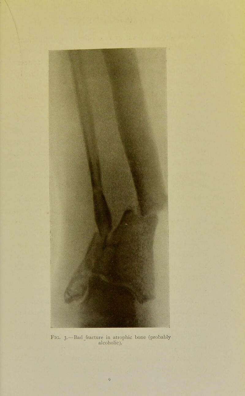 Fig. 3.—Bad fraclure in atrophic bone (probaljly alcoholic).