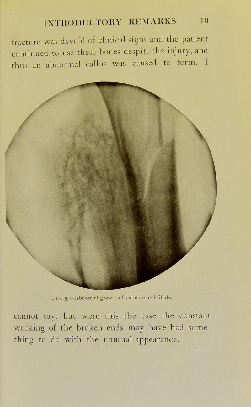 fracture was devoid of clinical signs and the patient continued to use these bones despite the injury, and thus an abnormal callus was caused to form, I Fu;. 5.—Abnormal growth of callus round fibula. cannot say, but were this the case the constant working of the broken ends may have had some- thing to do with the unusual appearance.