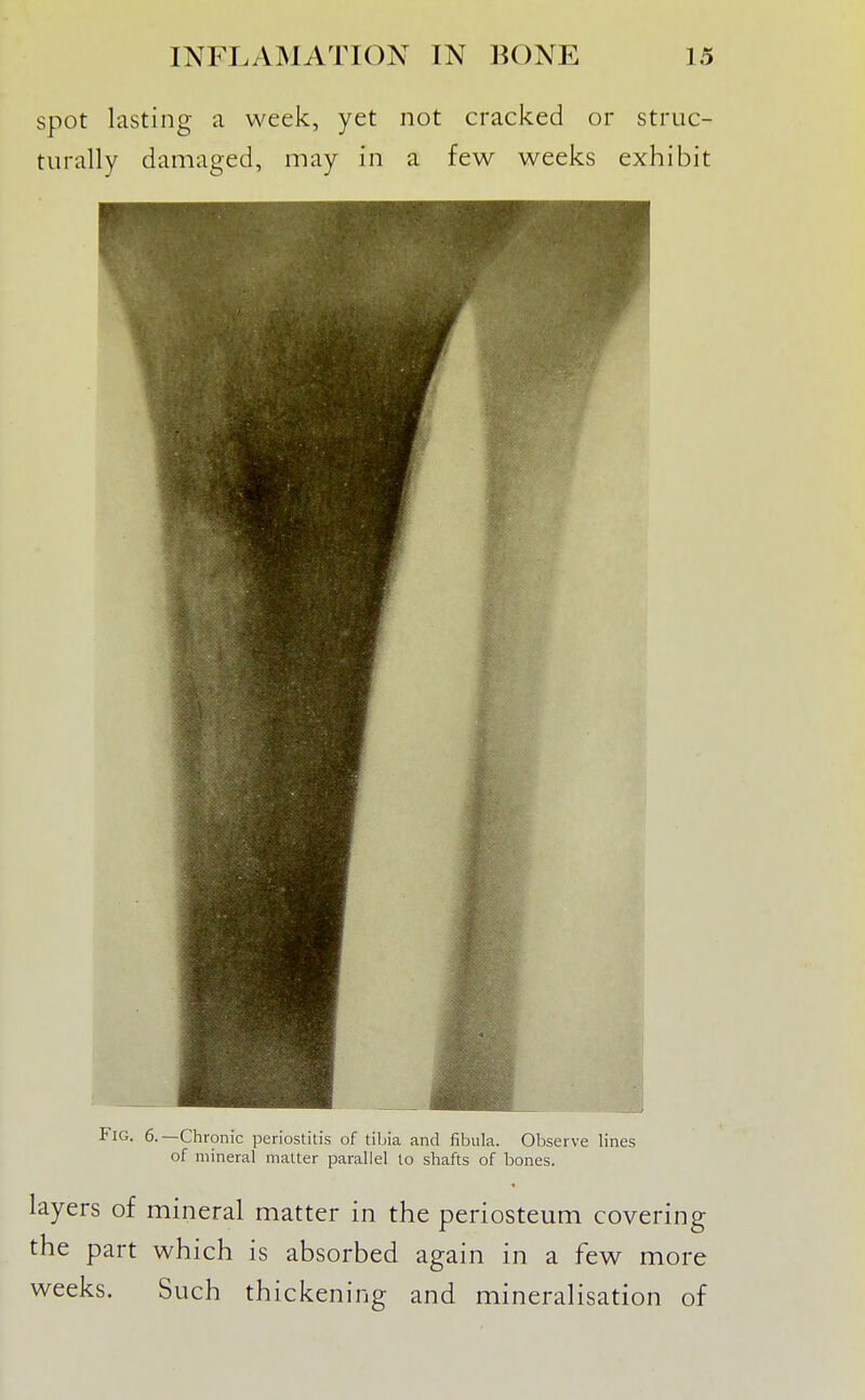 spot lasting a week, yet not cracked or struc- turally damaged, may in a few weeks exhibit I; I B Mbs»>£aaiiafcat...iwKaifc ■ liifta^Yia^ifa^ j Fig. 6.—Chronic periostitis of tibia and fibula. Observe lines of mineral matter parallel to shafts of bones. layers of mineral matter in the periosteum covering the part which is absorbed again in a few more weeks. Such thickening and mineralisation of