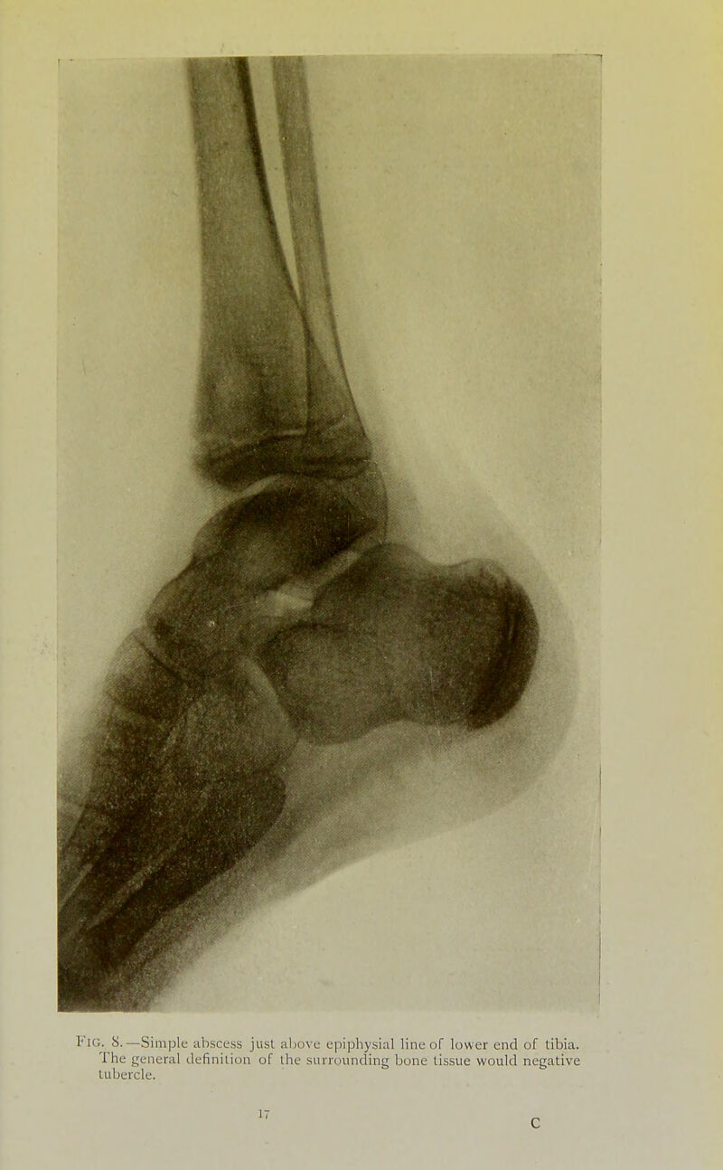 Fig. 8.—Simple abscess just above epiphysial line of lower end of tibia. The general definition of the surrounding bone tissue would negative tubercle.