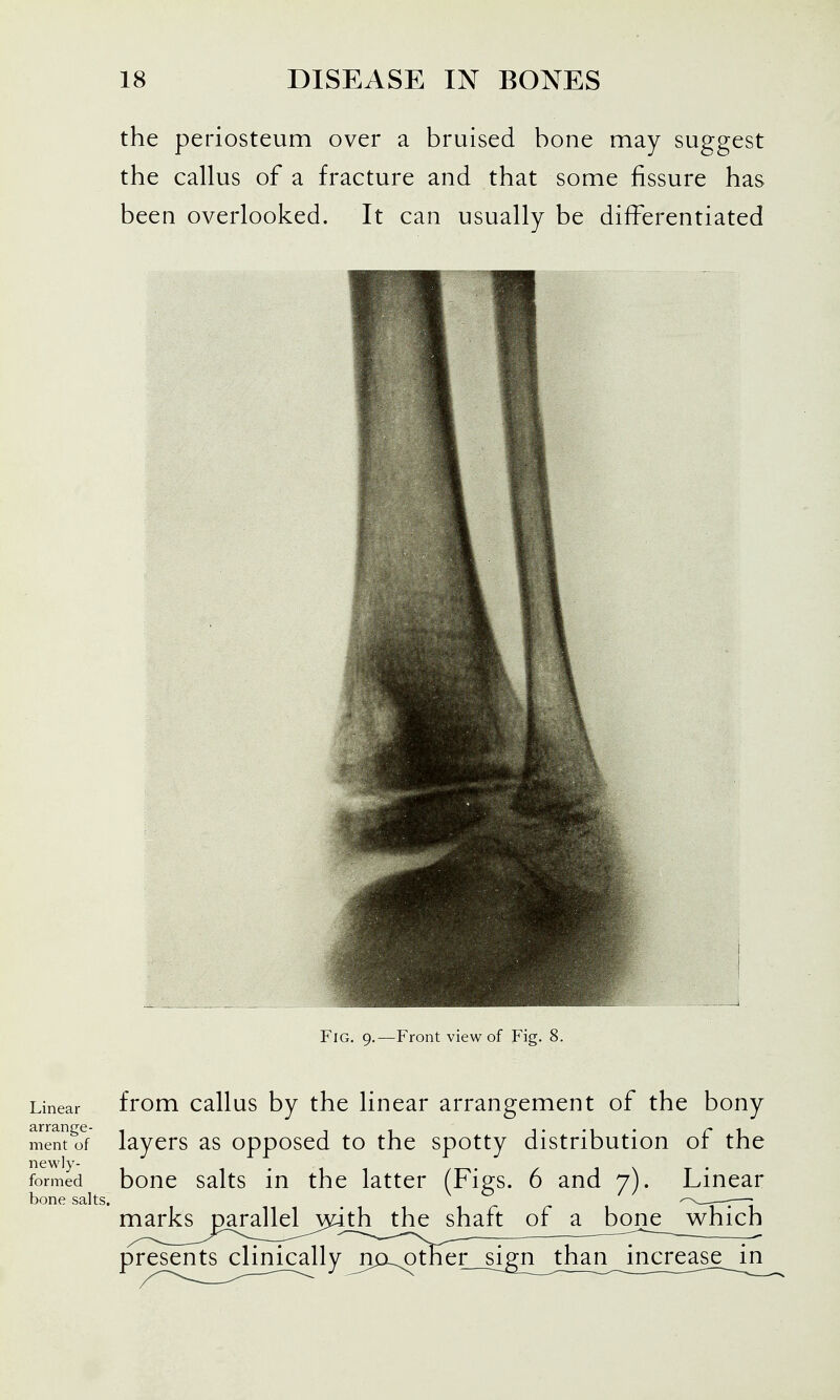 the periosteum over a bruised bone may suggest the callus of a fracture and that some fissure has been overlooked. It can usually be difi^erentiated Fig. 9.—Front view of Fig. 8. Linear tVom callus by the linear arrangement of the bony mentof laycrs as opposed to the spotty distribution or the newly- . formed boue salts in the latter (Figs. 6 and 7). Linear bone salts. ^^^-T:—i marks parallel with the shaft of a bone w^hich presents clinically^n0^tKer__si^n^^th^^