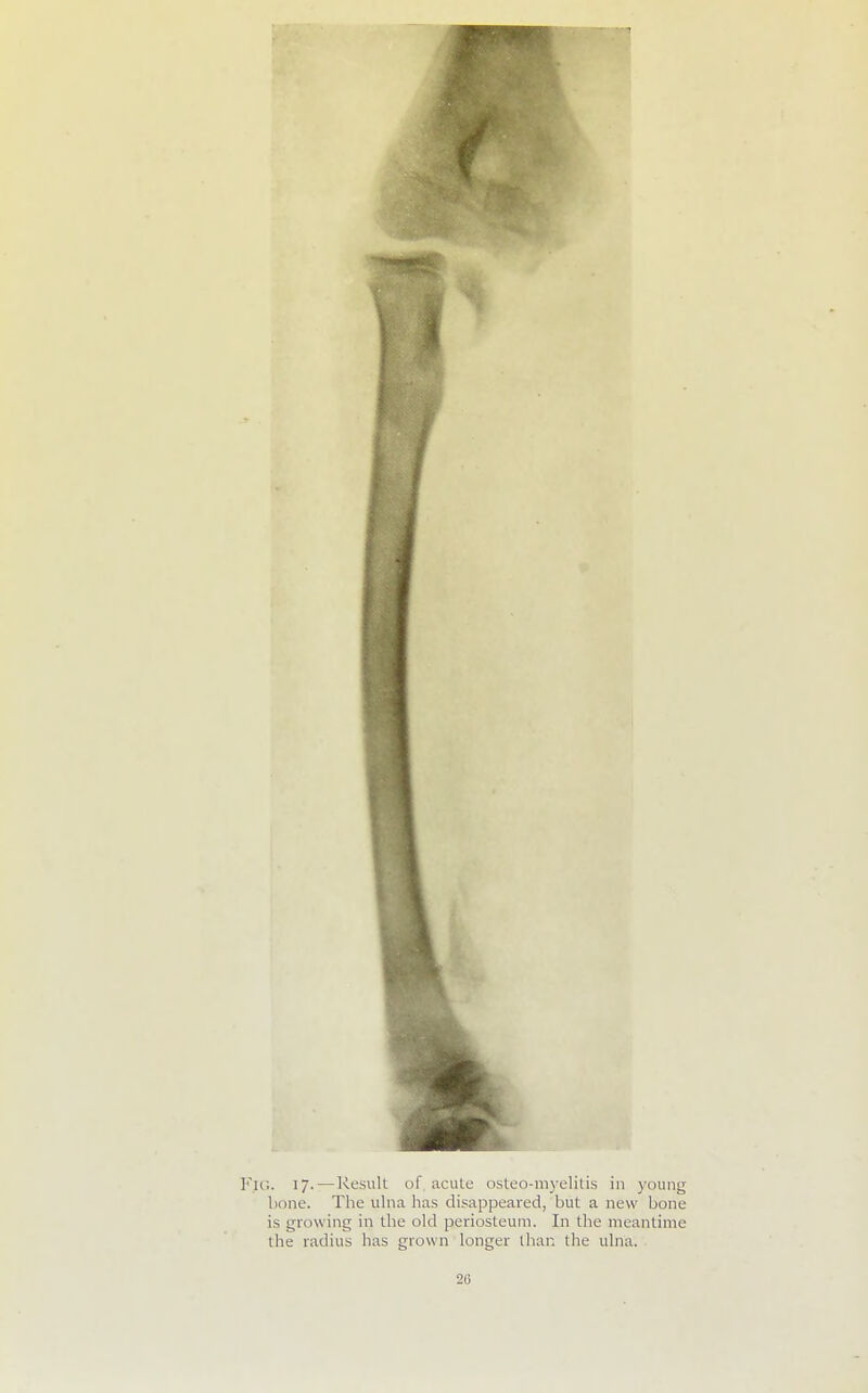 IG. 17.—Resull of acute osteo-myelitis in young bone. The ulna has disappeared, but a new bone is growing in the old periosteum. In the meantime the radius has grown longer than the ulna.