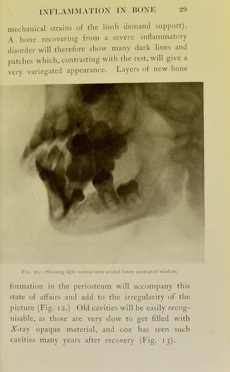 mechanical strains of the linib demand support). A bone recovering from a severe inflammatory disorder will therefore show many dark lines and Fig. 21.—Showing light normal area around lower unerupted wisdom. formation in the periosteum will accompany this state of affairs and add to the irregularity of the picture (Fig. 12.) Old cavities will be easily recog- nisable, as those are very slow to get filled with X-ray opaque material, and one has seen such cavities many years after recovery (Fig. 13).