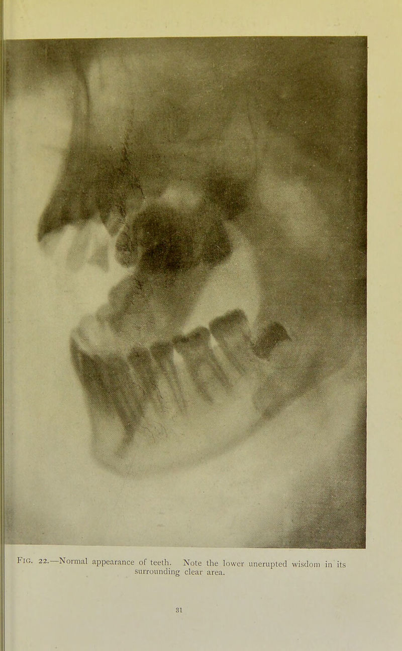 Fig. 22.—Normal appearance of teeth. Note the lower unerupted wisdom in its surrounding clear area.