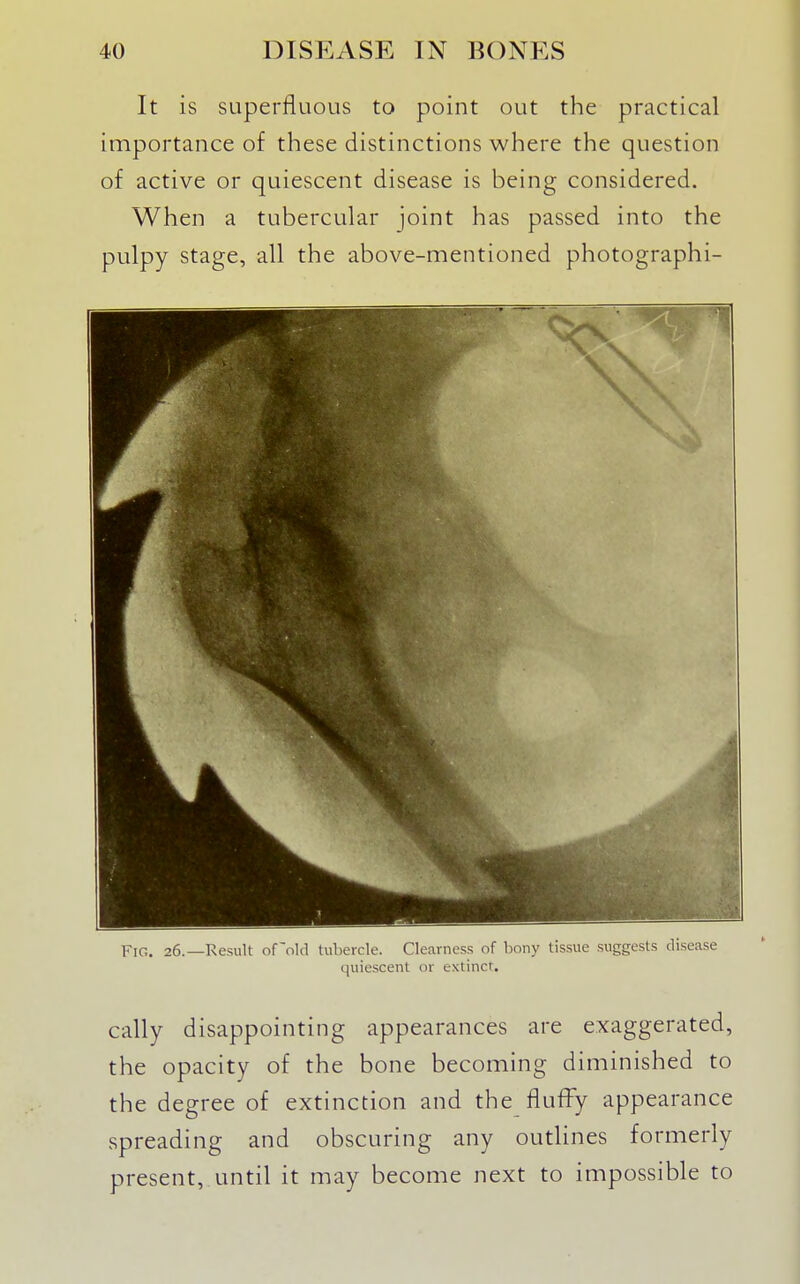 It is superfluous to point out the practical importance of these distinctions where the question of active or quiescent disease is being considered. When a tubercular joint has passed into the pulpy stage, all the above-mentioned photographi- FiG. 26.—Result of'okl tubercle. Clearness of bony tissue suggests disease quiescent or extinct. cally disappointing appearances are exaggerated, the opacity of the bone becoming diminished to the degree of extinction and the fluffy appearance spreading and obscuring any outlines formerly present, until it may become next to impossible to