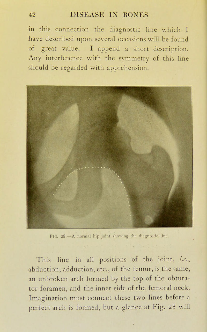 in this connection the diagnostic hne which I have described upon several occasions will be found of great value. I append a short description. Any interference with the symmetry of this line should be regarded with apprehension. Fic;. 28.—A normal hip joint showing the diagnostic line. This line in all positions of the joint, i.e., abduction, adduction, etc., of the femur, is the same, an unbroken arch formed by the top of the obtura- tor foramen, and the inner side of the femoral neck. Imagination must connect these two lines before a perfect arch is formed, but a glance at Fig. 28 will