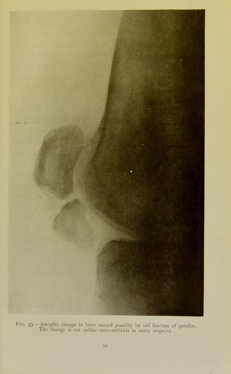 33. —Atrophic change in bone caused possilily by old fracture of patellee. The change is not unlii<e osteo-arthritis in many respects.