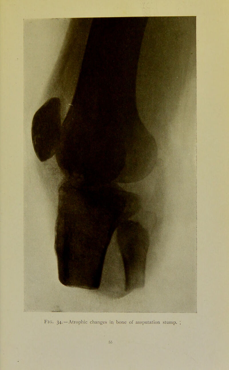 I' lc;. 34.—Atrophic changes in bone of amputation stump. ;