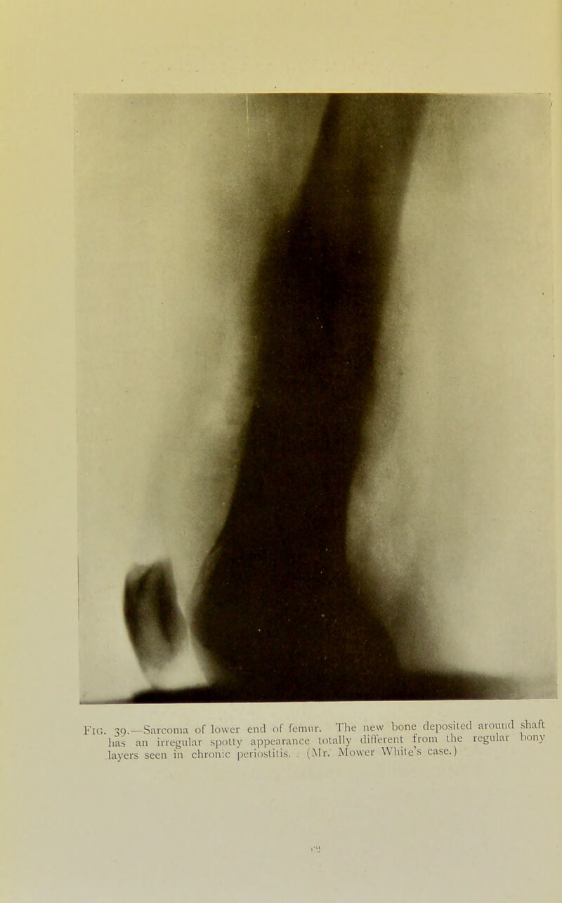 Fig. 39.—Sarcoma of lower end of fomiir. The new bone deposited around has an irregular spotty appearance totally different from the regular layers seen in chronic periostitis. (Mr. Mower White's case.)