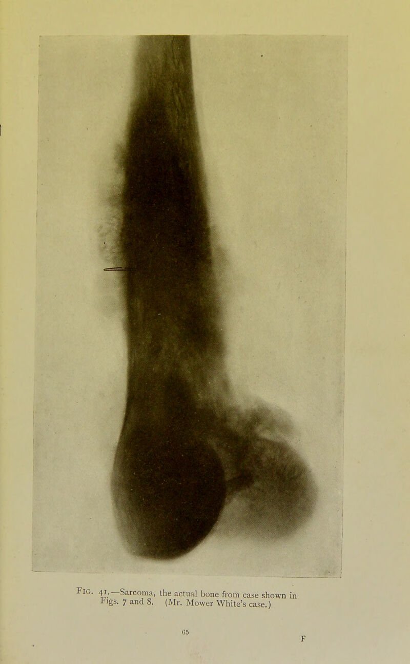 # '■ 41;—Sarcoma, the actual bone from case shown in I^igs. 7 and 8. (Mr. Mower White's case.) 05 F