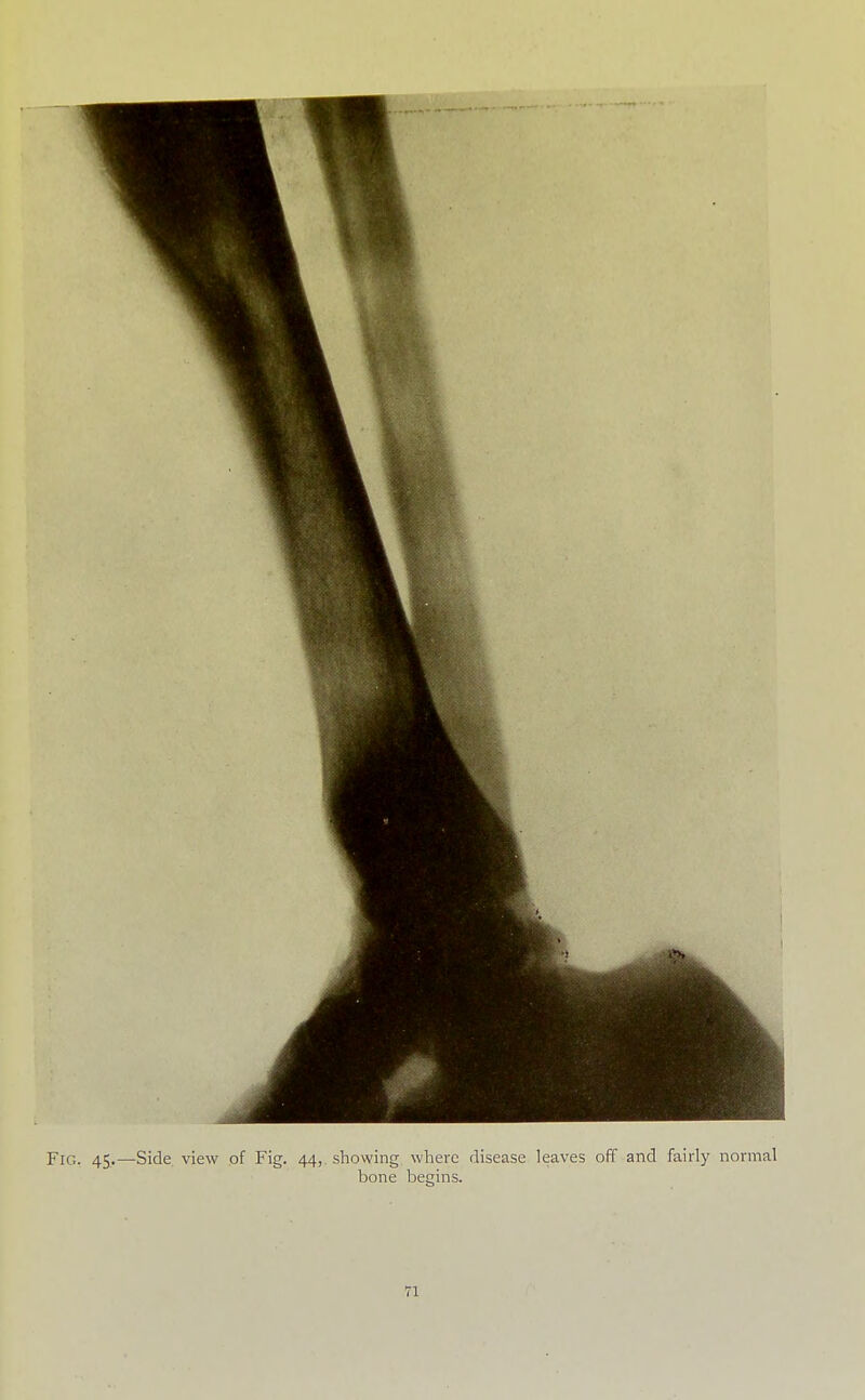 Fig. 45.—Side view of Fig. 44, showing where disease leaves off and fairly normal bone begins.