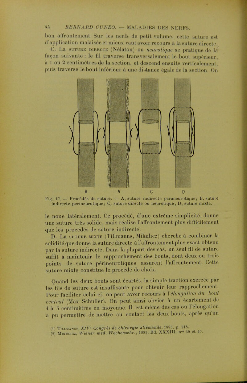 bon affrontement. Sur les nerfs de petit volume, cette suture est d'application malaisée et mieux vaut avoir recours à la suture directe G. La suture directe (Nélaton) ou neurotique se pratique de la façon suivante : le fil traverse transversalement le bout supérieur, à 1 ou 2 centimètres de la section, et descend ensuite verticalement, puis traverse le bout inférieur à une dislance égale de la section. On Fig. 17. — Procédés de suture. — A, suture indirecte paraneurotique; 13, suture indirecte perineurotique; C, suture directe ou neurotique; D, suture mixte. le noue latéralement. Ce procédé, d'une extrême simplicité, donne une suture très solide, mais réalise l'affrontement plus difficilement que les procédés de suture indirecte. D. La suture mixte (Tillmanns, Mikulicz) cherche à combiner la solidité que donne la suture directe à l'affrontement plus exact obtenu par la suture indirecte. Dans la plupart des cas, un seul fil de suture suffit à maintenir le rapprochement des bouts, dont deux ou trois points de suture périneurotiques assurent l'affrontement. Cette suture mixte constitue le procédé de choix. Quand les deux bouts sont écartés, la simple traction exercée par les fils de suture est insuffisante pour obtenir leur rapprochement. Pour faciliter celui-ci, on peut avoir recours à ïélongation du bout central (Max Schuller). On peut ainsi obvier à un écartement de 4 à 5 centimètres en moyenne. Il est même des cas où l'élongalion a pu permettre démettre au contact les deux bouts, après qu'un (1) Tillmanns, XIV« Congrès de chirurgie allemande, 1885. p. 218. (2) Mikulicz, Wiener med. Wochenschr., 1883, Bd. XXXIII, n°» 39 et 40.