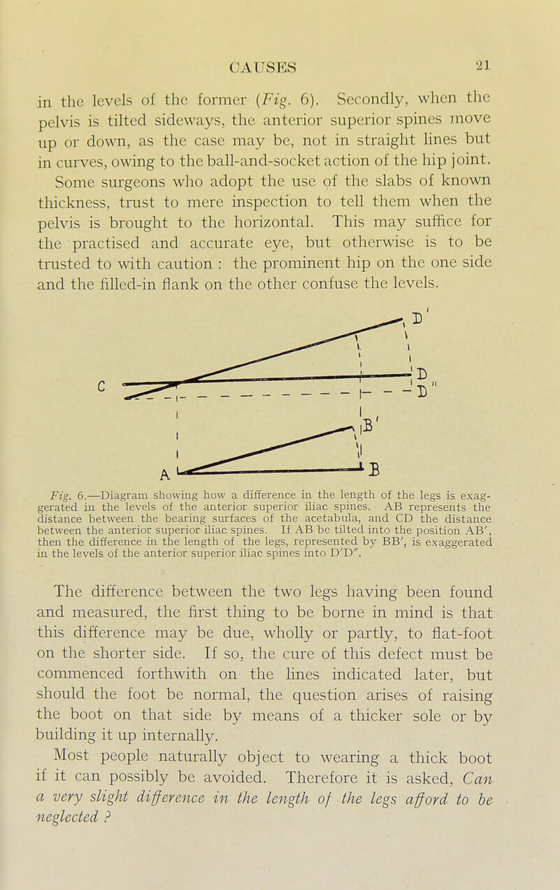 in the levels of the former (Fig. 6). Secondly, when the pelvis is tilted sideways, the anterior superior spines move up or down, as the case may be, not in straight lines but in curves, owing to the ball-and-socket action of the hip joint. Some surgeons who adopt the use of the slabs of known thickness, trust to mere inspection to tell them when the pelvis is brought to the horizontal. This may suffice for the practised and accurate eye, but otherwise is to be trusted to with caution : the prominent hip on the one side and the filled-in flank on the other confuse the levels. C Fig. 6.—Diagram showing how a difference in the length of the legs is exag- gerated in the levels of the anterior superior iliac spines. AB represents the distance between the bearing surfaces of the acetabula, and CD the distance between the anterior superior iliac spines. If AB be tilted into the position AB', then the difference in the length of the legs, represented by BB', is exaggerated in the levels of the anterior superior iliac spines into D'D. The difference between the two legs having been found and measured, the first thing to be borne in mind is that this difference may be due, wholly or partly, to flat-foot on the shorter side. If so, the cure of this defect must be commenced forthwith on the lines indicated later, but should the foot be normal, the question arises of raising the boot on that side by means of a thicker sole or by building it up internally. Most people naturally object to wearing a thick boot if it can possibly be avoided. Therefore it is asked, Can a very slight difference in the length of the legs afford to be neglected ?