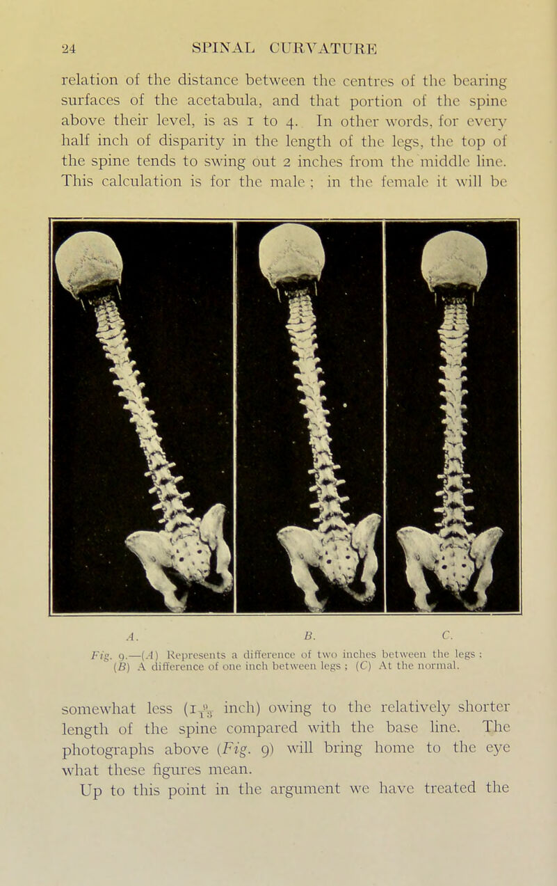 relation of the distance between the centres of the bearing surfaces of the acetabula, and that portion of the spine above their level, is as i to 4. In other words, for every half inch of disparity in the length of the legs, the top of the spine tends to swing out 2 inches from the middle line. This calculation is for the male : in the female it will be A. B. C. Fig. 9.—(.-I) Represents a difference of two inches between the legs; (B) A difference of one inch between legs ; (C) At the normal. somewhat less (1^., inch) owing to the relatively shorter length of the spine compared with the base line. The photographs above (Fig. 9) will bring home to the eye what these figures mean. Up to this point in the argument we have treated the