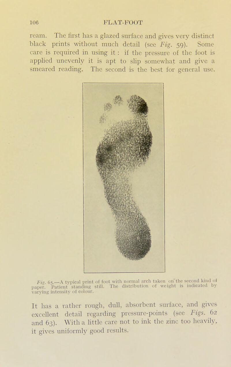 ream. The first has a glazed surface and gives very distinct black prints without much detail (sec Fig. 59). Some care is required in using it : if the pressure of the foot is applied unevenly it is apt to slip somewhat and give a smeared reading. The second is the best for general use. p,„. 55.—.\ typical print of foot with normal arch taken on'the second kind of paper. Patient' standing still. The distribution of weight is indicated In- varying intensity of colour. It has a rather rough, dull, absorbent surface, and gives excellent detail regarding pressure-points (see Figs. 62 and 63). With a little care not to ink the zinc too heavily, it gives uniformly good results.