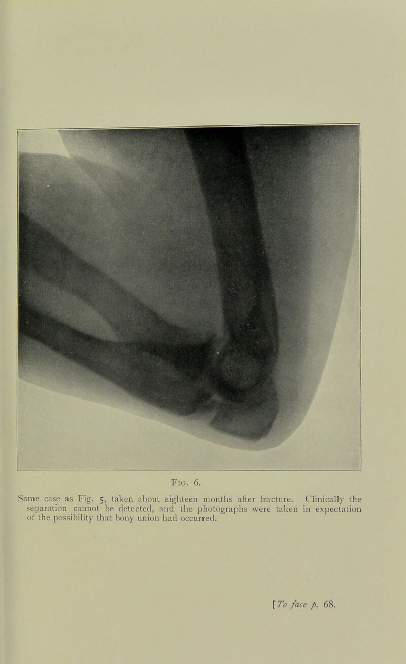 Same case as Fig. 5, taken about eighteen months after fracture. Clinical))- the separation cannot be detected, and the photographs were taken in expectation of the possibility that bony union had occurred.