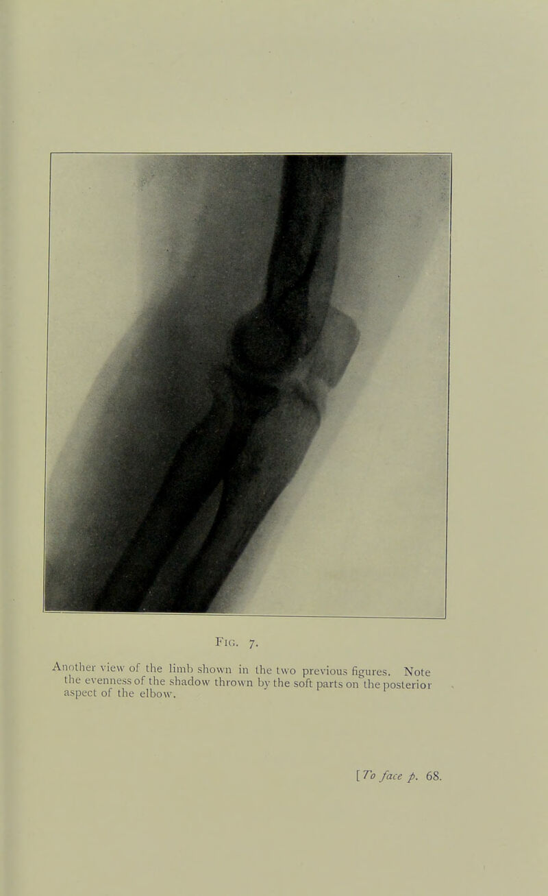 Fk;. 7. Anntliei- view of the limb shown in the two previous figures. Note the evenness of the shadow thrown bv the soft parts on the posterior aspect of the elbow.