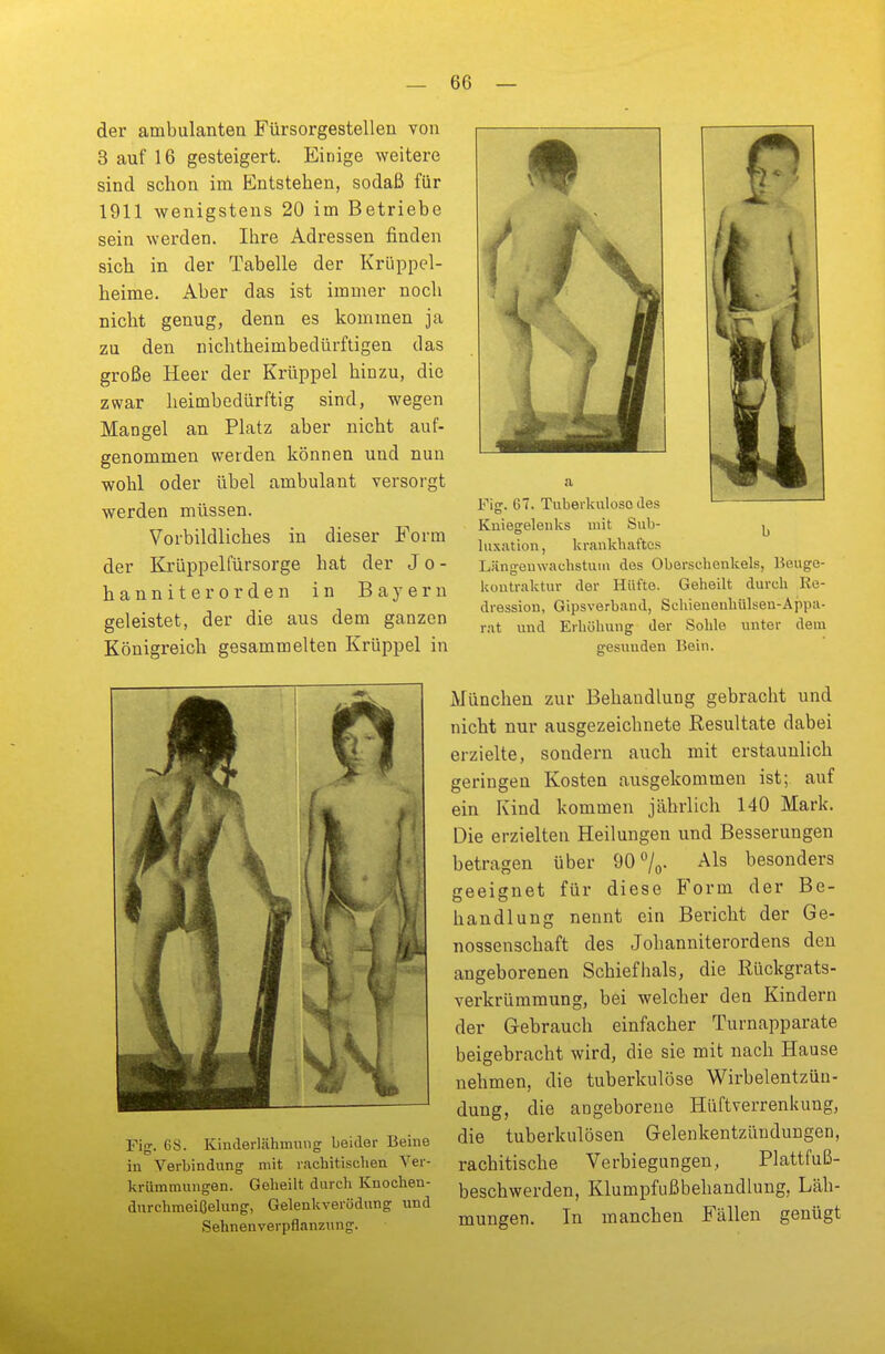 der ambulanten Fürsorgestellen von 3 auf 16 gesteigert. Einige weitere sind schon im Entstehen, sodaß für 1911 wenigstens 20 im Betriebe sein werden. Ibre Adressen finden sich in der Tabelle der Krüppel- heime. Aber das ist immer noch nicht genug, denn es kommen ja zu den nichtheimbedürftigen das große Heer der Krüppel hinzu, die zwar heimbedürftig sind, wegen Mangel an Platz aber nicht auf- genommen werden können und nun wohl oder übel ambulant versorgt werden müssen. Vorbildliches in dieser Form der Krüppelfürsorge bat der Jo- hanniter orden in Bayern geleistet, der die aus dem ganzen Königreich gesammelten Krüppel in Fig. GS. Kinderlähmung beider Beine in Verbindung mit rachitischen Ver- krümmungen. Geheilt durch Knochen- durchmeißelung, Gelenkverödung und Sehnenverpflanzung. Fig. 67. Tuberkulüso des Kniegelenks mit Sub- ^ luxation, krankhaftes Längenwachstum des Oberschenkels, Beuge- kontraktur der Hüfte. Geheilt durch Re- dression, Gipsverband, Schienenhülsen-Appa- rat und Erhöhung der Sohle unter dein gesunden Bein. München zur Behandlung gebracht und nicht nur ausgezeichnete Resultate dabei erzielte, sondern auch mit erstaunlich geringen Kosten ausgekommen ist; auf ein Kind kommen jährlich 140 Mark. Die erzielten Heilungen und Besserungen betragen über 90°/0. Als besonders geeignet für diese Form der Be- handlung nennt ein Bericht der Ge- nossenschaft des Jobanniterordens den angeborenen Schiefhals, die Rückgrats- verkrümmung, bei welcher den Kindern der Gebrauch einfacher Turnapparate beigebracht wird, die sie mit nach Hause nehmen, die tuberkulöse Wirbelentzün- dung, die angeborene Hüftverrenkung, die tuberkulösen Gelenkentzündungen, rachitische Verbiegungen, Plattfuß- beschwerden, Klumpfußbehandlung, Läh- mungen. In manchen Fällen genügt