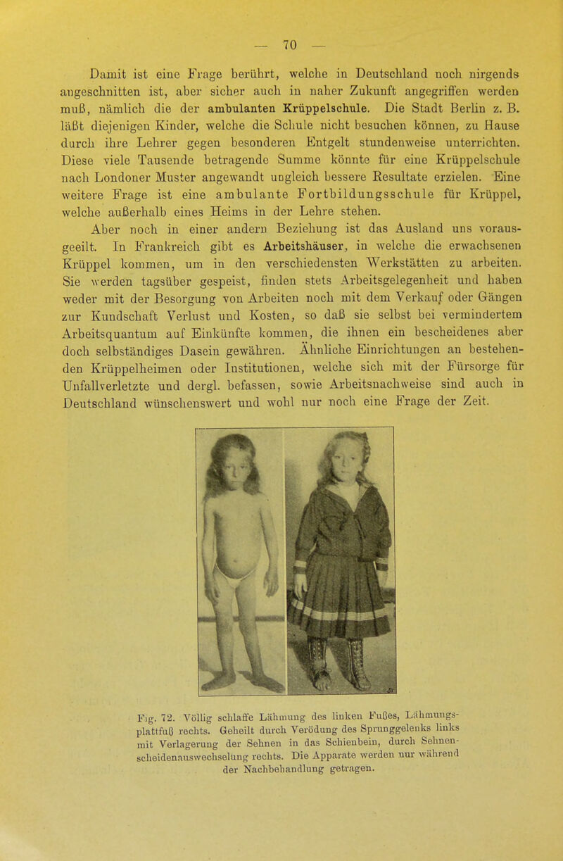 Damit ist eine Frage berührt, welche in Deutschland noch nirgends angeschnitten ist, aber sicher auch in naher Zukunft angegriffen werden muß, nämlich die der ambulanten Krüppelschule. Die Stadt Berlin z. B. läßt diejenigen Kinder, welcbe die Schule nicht besuchen können, zu Hause durch ihre Lehrer gegen besonderen Entgelt stundenweise unterrichten. Diese viele Tausende betragende Summe könnte für eine Krüppelschule nach Londoner Muster angewandt ungleich bessere Resultate erzielen. Eine weitere Frage ist eine ambulante Fortbildungsschule für Krüppel, welche außerhalb eines Heims in der Lehre stehen. Aber noch in einer andern. Beziehung ist das Ausland uns voraus- geeilt. In Frankreich gibt es Arbeitshäuser, in welche die erwachsenen Krüppel kommen, um in den verschiedensten Werkstätten zu arbeiten. Sie werden tagsüber gespeist, finden stets Arbeitsgelegenheit und haben weder mit der Besorgung von Arbeiten noch mit dem Verkauf oder Gängen zur Kundschaft Verlust und Kosten, so daß sie selbst bei vermindertem Arbeitsquantum auf Einkünfte kommen, die ihnen ein bescheidenes aber doch selbständiges Dasein gewähren. Ähnliche Einrichtungen an bestehen- den Krüppelheimen oder Institutionen, welche sich mit der Fürsorge für Unfallverletzte und dergl. befassen, sowie Arbeitsnachweise sind auch in Deutschland wünschenswert und wohl nur noch eine Frage der Zeit. Fig. 72. Völlig schlaffe Lähmung des linken Fußes, Lahmuugs- plattfuß rechts. Geheilt durch Verödung des Sprunggelenks links mit Verlagerung der Sehnen in das Schienbein, durch Sehnen- scheidenauswechseluug rechts. Die Apparate werden nur während der Nachbehandlung getragen.
