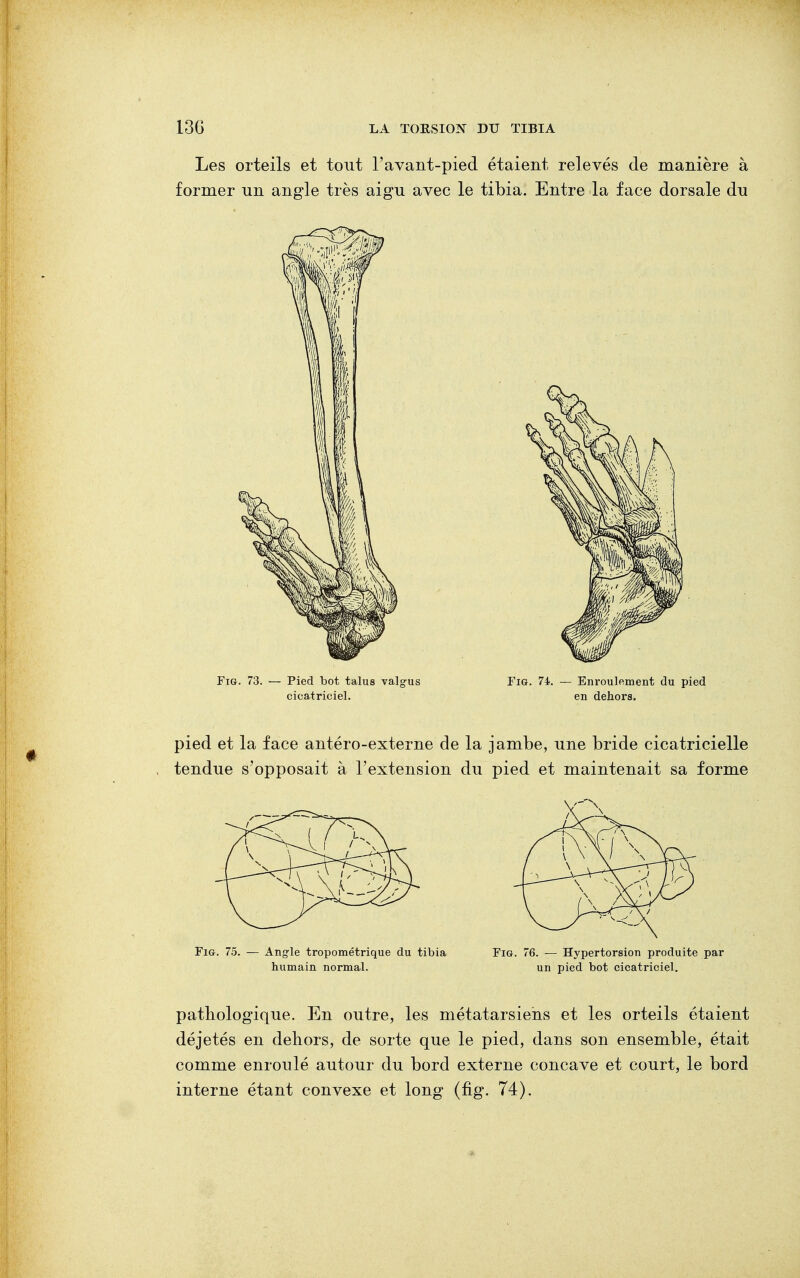 pied et la face antéro-externe de la jambe, une bride cicatricielle tendue s'opposait à l'extension du pied et maintenait sa forme Fig. 75. — Angle tropométrique du tibia Fig. 76. — Hypertorsion produite par humain normal. un pied bot cicatriciel. pathologique. En outre, les métatarsiens et les orteils étaient déjetés en dehors, de sorte que le pied, dans son ensemble, était comme enroulé autour du bord externe concave et court, le bord interne étant convexe et long (fig. 74).