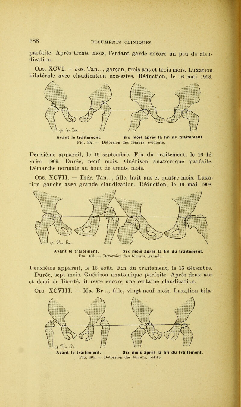 parfaite. Après trente mois, l'enfant garde encore un peu de clau- dication. Obs. XCVI. — Jos. Tan..., garçon, trois ans et trois mois. Luxation bilatérale avec claudication excessive. Réduction, le 16 mai 1908. Avant le traitement. Six mois après la fin du traitement. Fig. 462. — Détorsion des fémurs, évidente. Deuxième appareil, le 16 septembre. Fin du traitement, le 16 fé- vrier 1909. Durée, neuf mois. Guérison anatomique parfaite. Démarche normale au bout de trente mois. Obs. XCVII. — Thér. Tan..., fille, huit ans et quatre mois. Luxa- tion gauche avec grande claudication. Réduction, le 16 mai 1908. Avant le traitement. Six mois après la fin du traitement. Fia. 463. — Détorsion des fémurs, grande. Deuxième appareil, le 18 août. Fin du traitement, le 16 décembre. Durée, sept mois. Guérison anatomique parfaite. Après deux ans et demi de liberté, il reste encore une certaine claudication. Obs. XCVIII. — Ma. Br..., fille, vingt-neuf mois. Luxation bila- Avant le traitement. Six mois après la fin du traitement. Fig. 464. — Détorsion des fémurs, petite.