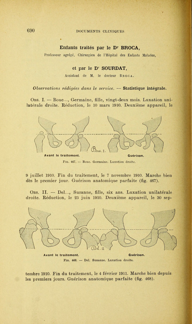 Enfants traités par le Dr BROC A, Professeur agrégé, Chirurgien de l'Hôpital des Enfants Malades, et par le Dr SOURDAT, Assistant de M. le docteur Broc a. Observations rédigées dans le service. — Statistique intégrale. Obs. I. — Bouc.., Germaine, fille, vingt-deux mois. Luxation uni- latérale droite. Réduction, le 10 mars 1910. Deuxième appareil, le Avant le traitement. Guérison. Fig. 467. — Bouc. Germaine. Luxation droite. 9 juillet 1910. Fin du traitement, le 7 novembre 1910. Marche bien dès le premier jour. Guérison anatomique parfaite (fig. 46V). Obs. II. — Del..., Suzanne, fille, six ans. Luxation unilatérale droite. Réduction, le 23 juin 1910. Deuxième appareil, le 30 sep- tembre 1910. Fin du traitement, le 4 février 1911. Marche bien depuis les premiers jours. Guérison anatomique parfaite (fig. 468).