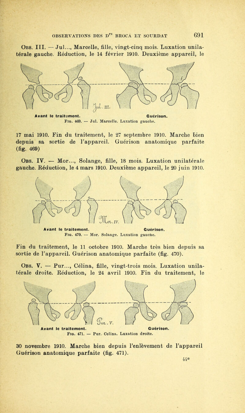 Obs. III. — Jul..., Marcelle, fille, vingt-cinq mois. Luxation unila- térale gauche. .Réduction, le 14 février 1910. Deuxième appareil, le Avant le traitement. Cuérison. Fig. 469. — Jul. Marcelle. Luxation gauche. 17 mai 1910. Fin du traitement, le 27 septembre 1910. Marche bien depuis sa sortie de l'appareil. Guérison anatomique parfaite (fig. 469) Obs. IV. — Mor..., Solange, fille, 18 mois. Luxation unilatérale gauche. Eéduction, le 4 mars 1910. Deuxième appareil, le 20 juin 1910. Avant le traitement. Guérison. Fig. 470. — Mor. Solange. Luxation gauche. Fin du traitement, le 11 octobre 1910. Marche très bien depuis sa sortie de l'appareil. Guérison anatomique parfaite (fig. 470). Obs. V. — Pur..., Célina, fille, vingt-trois mois. Luxation unila- térale droite. Réduction, le 24 avril 1910. Fin du traitement, le Avant le traitement. Guérison. Fig. 471. — Pur. Celina. Luxation droite. 30 novembre 1910. Marche bien depuis l'enlèvement de l'appareil Guérison anatomique parfaite (fig. 471). 44*