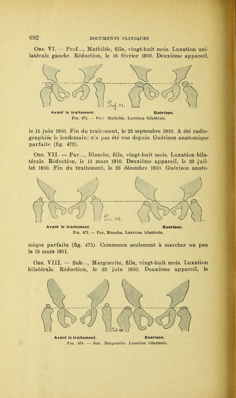 Obs. VI. — Prof..., Mathilde, fille, vingt-huit mois. Luxation uni- latérale gauche. Réduction, le 16 février 1910. Deuxième appareil, Avant le traitement. Guérison. Fig. 472. — Prof. Mathilde. Luxation bilatérale. le 15 juin 1910. Fin du traitement, le 22 septembre 1910. A été radio- graphiée le lendemain; n'a pas été vue depuis. Guérison anatomique parfaite (fig. 472). Obs. VII. — Par..., Blanche, fille, vingt-huit mois. Luxation bila- térale. Réduction, le 15 mars 1910. Deuxième appareil, le 23 juil- let 1910. Fin du traitement, le 23 décembre 1910. Guérison anato- Avant le traitement. Guérison. Fig. 473. — Par. Blanche. Luxation bilatérale. mique parfaite (fig. 473). Commence seulement à marcher un peu le 15 mars 1911. Obs. VIII. — Sab..., Marguerite, fille, vingt-huit mois. Luxation bilatérale. Réduction, le 23 juin 1910. Deuxième appareil, le Avant le traitement. Guérison. Fig. 474. — Sab. Marguerite. Luxation bilatérale.