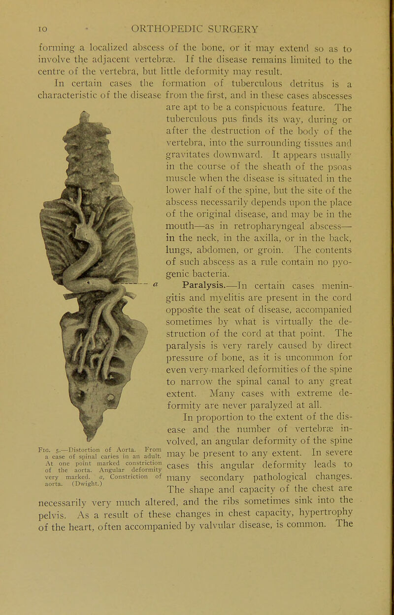 forming a localized abscess of the bone, or it may extend so as to involve the adjacent vertebrae. If the disease remains limited to the centre of the vertebra, but little deformity may result. In certain cases the formation of tuberculous detritus is a characteristic of the disease from the first, and in these cases abscesses are apt to be a conspicuous feature. The tuberculous pus finds its way, during- or after the destruction of the body of the vertebra, into the surrounding tissues and gravitates downward. It appears usually in the course of the sheath of the psoas muscle when the disease is situated in the lower half of the spine, but the site of the abscess necessarily depends upon the place of the original disease, and may be in the mouth—as in retropharyngeal abscess— in the neck, in the axilla, or in the back, lungs, abdomen, or groin. The contents of such abscess as a rule contain no pyo- genic bacteria. Paralysis—In certain cases menin- gitis and myelitis are present in the cord opposite the seat of disease, accompanied sometimes by what is virtually the de- struction of the cord at that point. The paralysis is very rarely caused by direct pressure of bone, as it is uncommon for even very marked deformities of the spine to narrow the spinal canal to any great extent. Many cases with extreme de- formity are never paralyzed at all. In proportion to the extent of the dis- ease and the number of vertebras in- volved, an angular deformity of the spine may be present to any extent. In severe cases this angular deformity leads to many secondary pathological changes. The shape and capacity of the chest are necessarily very much altered, and the ribs sometimes sink into the pelvis. As a result of these changes in chest capacity, hypertrophy of the heart, often accompanied by valvular disease, is common Fig. 5.—Distortion of Aorta. From a case of spinal caries in an adult. At one point marked constriction of the aorta. Angular deformity very marked. a, Constriction of aorta. (Dwight.) The