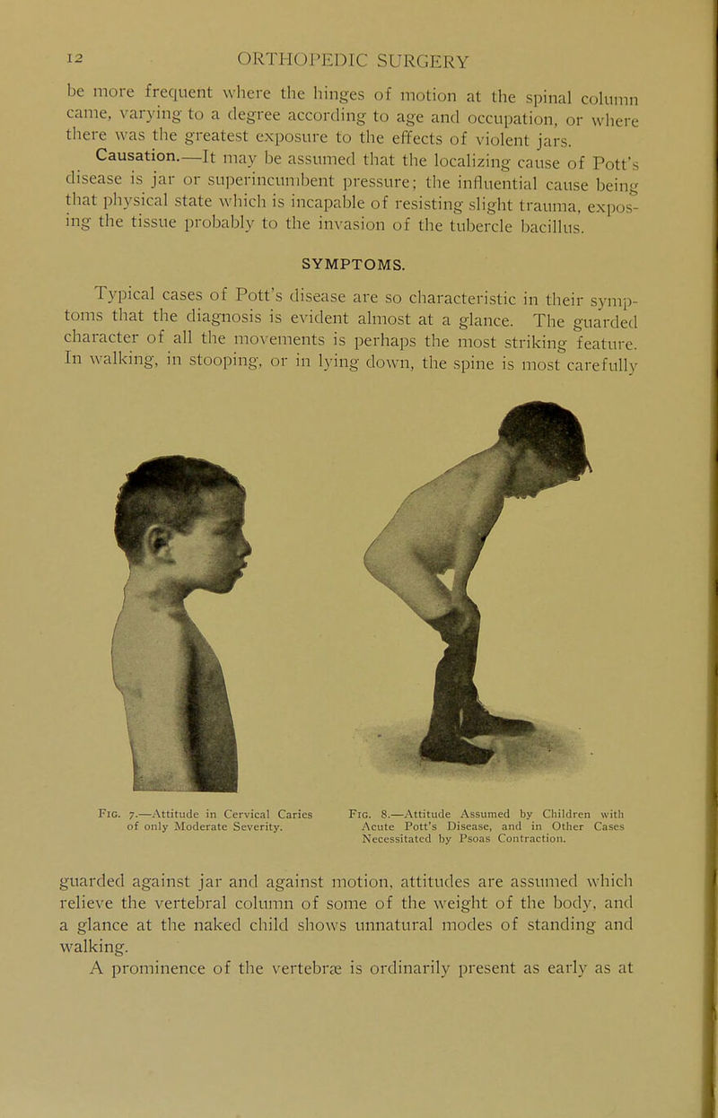 be more frequent where the hinges of motion at the spinal column came, varying to a degree according to age and occupation, or where there was the greatest exposure to the effects of violent jars. Causation.—It may be assumed that the localizing cause of Pott's disease is jar or superincumbent pressure; the influential cause being that physical state which is incapable of resisting slight trauma, expos- ing the tissue probably to the invasion of the tubercle bacillus. SYMPTOMS. Typical cases of Pott's disease are so characteristic in their symp- toms that the diagnosis is evident almost at a glance. The guarded character of all the movements is perhaps the most striking feature. Fig. 7.—Attitude in Cervical Caries Fig. 8.—Attitude Assumed by Children with of only Moderate Severity. Acute Pott's Disease, and in Other Cases Necessitated by Psoas Contraction. guarded against jar and against motion, attitudes are assumed which relieve the vertebral column of some of the weight of the body, and a glance at the naked child shows unnatural modes of standing and walking. A prominence of the vertebras is ordinarily present as early as at