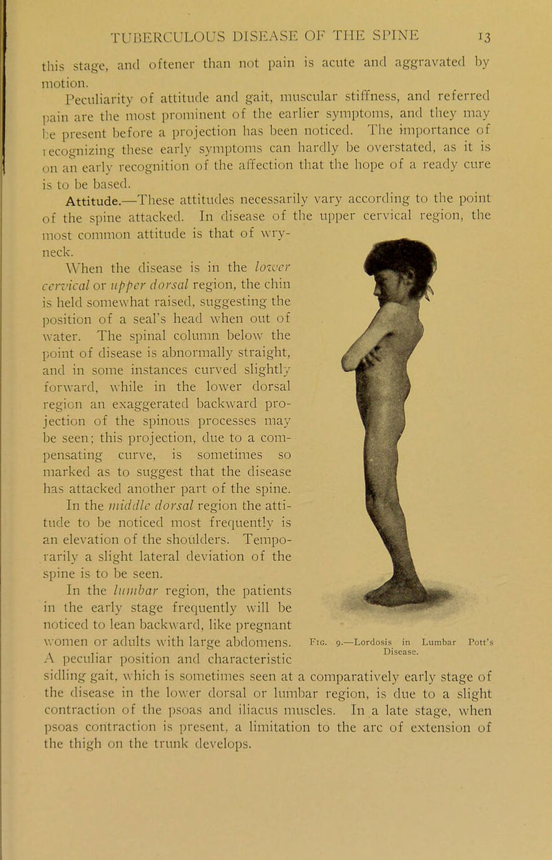 this stage, and oftener than not pain is acute and aggravated by motion. Peculiarity of attitude and gait, muscular stiffness, and referred pain are the most prominent of the earlier symptoms, and they may be present before a projection has been noticed. The importance of recognizing these early symptoms can hardly be overstated, as it is (.n an early recognition of the affection that the hope of a ready cure is to be based. Attitude.—These attitudes necessarily vary according to the point of the spine attacked. In disease of the upper cervical region, the most common attitude is that of wry- neck. When the disease is in the lower cervical or upper dorsal region, the chin is held somewhat raised, suggesting the position of a seal's head when out of water. The spinal column below the point of disease is abnormally straight, and in some instances curved slightly forward, while in the lower dorsal region an exaggerated backward pro- jection of the spinous processes may be seen; this projection, due to a com- pensating curve, is sometimes so marked as to suggest that the disease has attacked another part of the spine. In the middle dorsal region the atti- tude to be noticed most frequently is an elevation of the shoulders. Tempo- rarily a slight lateral deviation of the spine is to be seen. In the lumbar region, the patients in the early stage frequently will be noticed to lean backward, like pregnant WOmen Or adults with large abdomens. Fig. 9.—Lordosis in Lumbar Pott's . . • . . . . . Disease. .\ peculiar position and characteristic sidling gait, which is sometimes seen at a comparatively early stage of the disease in the lower dorsal or lumbar region, is due to a slight contraction of the psoas and iliacus muscles. In a late stage, when psoas contraction is present, a limitation to the arc of extension of the thigh on the trunk develops.