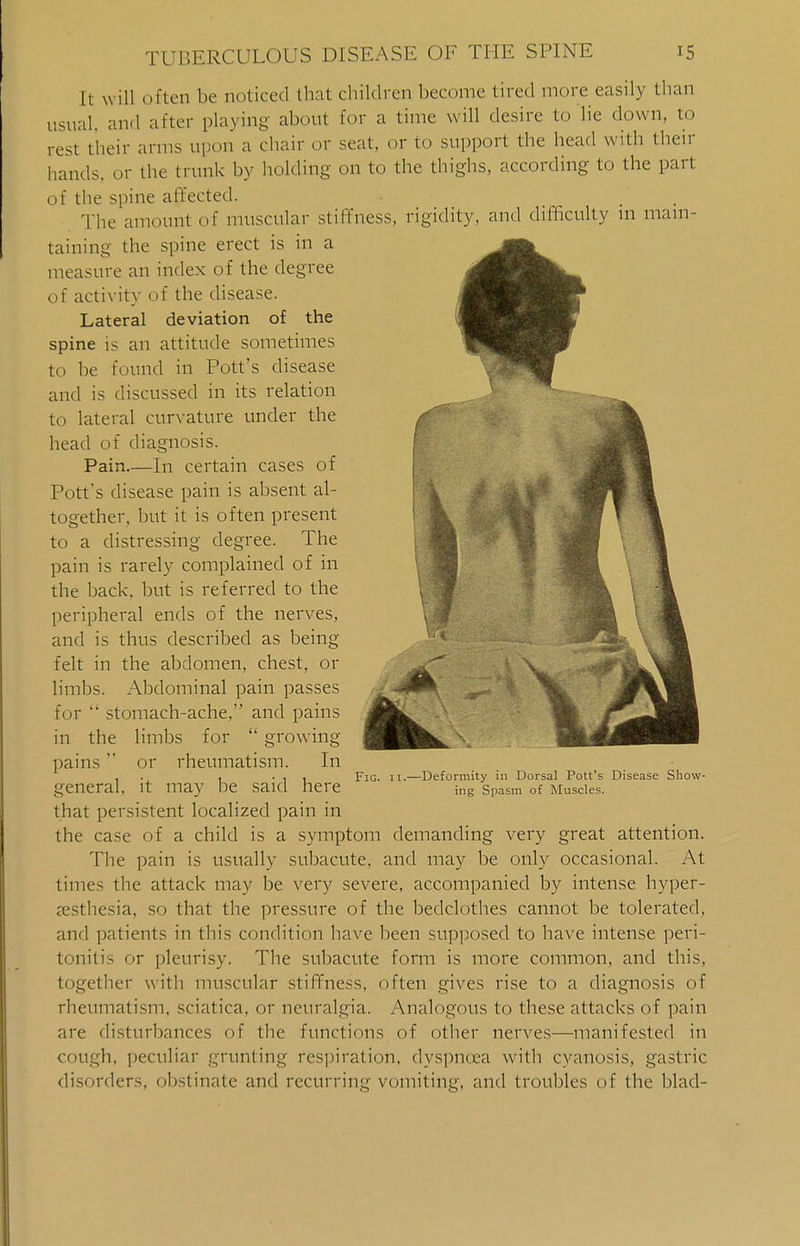 It will often be noticed that children become tired more easily than usual, and after playing about for a time will desire to lie down, to rest their arms upon a chair or seat, or to support the head with then- hands, or the trunk by holding on to the thighs, according to the part of the spine affected. The amount of muscular stiffness, rigidity, and difficulty 111 main- taining the spine erect is in a measure an index of the degree of activity of the disease. Lateral deviation of the spine is an attitude sometimes to be found in Pott's disease and is discussed in its relation to lateral curvature under the head of diagnosis. Pain.—In certain cases of Pott's disease pain is absent al- together, but it is often present to a distressing degree. The pain is rarely complained of in the back, but is referred to the peripheral ends of the nerves, and is thus described as being felt in the abdomen, chest, or limbs. Abdominal pain passes for  stomach-ache, and pains in the limbs for  growing pains  or rheumatism. In ... , -11 Fig. 11.—Deformity in Dorsal Pott's Disease Show- general, it may be said here ing spasm of Muscles. that persistent localized pain in the case of a child is a symptom demanding very great attention. The pain is usually subacute, and may be only occasional. At times the attack may be very severe, accompanied by intense hyper- esthesia, so that the pressure of the bedclothes cannot be tolerated, and patients in this condition have been supposed to have intense peri- tonitis or pleurisy. The subacute form is more common, and this, together with muscular stiffness, often gives rise to a diagnosis of rheumatism, sciatica, or neuralgia. Analogous to these attacks of pain are disturbances of the functions of other nerves—manifested in cough, peculiar grunting respiration, dyspnoea with cyanosis, gastric disorders, obstinate and recurring vomiting, and troubles of the blad-