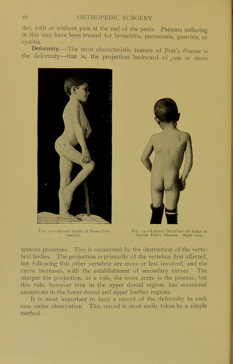 der, with or without pain at the end of the penis. Patients suffering in this way have been treated for bronchitis, pneumonia, gastritis, or cystitis. Deformity.—The most characteristic feature of Pott's disease is the deformity—that is, the projection backward of one or more Fig. 12.—Severe Grade of Psoas Con- Fic. 13.—Lateral Deviation of Spine in traction. Dorsal Pott's Disease. Back view. spinous processes. This is occasioned by the destruction of the verte- bral bodies. The projection is primarily of the vertebras first affected, but following this other vertebra? are more or less involved, and the curve increases, with the establishment of secondary curves. The sharper the projection, as a rule, the more acute is the process; but this rule, however true in the upper dorsal region, has occasional exceptions in the lower dorsal and upper lumbar regions. It is most important to keep a record of the deformity in each case under observation. This record is most easily taken by a simple method.