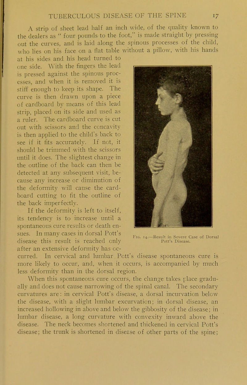 A strip of sheet lead half an inch wide, of the quality known to the dealers as  tour pounds to the foot, is made straight by pressing out the curves, and is laid along the spinous processes of the child, who lies on his face on a Hat table without a pillow, with his hands at his sides and his head turned to one side. With the fingers the lead is pressed against the spinous proc- esses, and when it is removed it is stiff enough to keep its shape. The curve is then drawn upon a piece of cardboard by means of this lead strip, placed on its side and used as a ruler. The cardboard curve is cut out with scissors and the concavity is then applied to the child's back to see if it fits accurately. If not, it should be trimmed with the scissors until it does. The slightest change in the outline of the back can then be detected at any subsequent visit, be- cause any increase or diminution of the deformity will cause the card- board cutting to fit the outline of the back imperfectly. If the deformity is left to itself, its tendency is to increase until a spontaneous cure results or death en- sues. In many cases in dorsal Pott's disease this result is reached only after an extensive deformity has oc- curred. In cervical and lumbar Pott's disease spontaneous cure is more likely to occur, and, when it occurs, is accompanied by much less deformity than in the dorsal region. When this spontaneous cure occurs, the change takes {dace gradu- ally and does not cause narrowing of the spinal canal. The secondary curvatures are: in cervical Pott's disease, a dorsal incurvation below the disease, with a slight lumbar excurvation; in dorsal disease, an increased hollowing in above and below the gibbosity of the disease; in lumbar disease, a long curvature with convexity inward above the disease. The neck becomes shortened and thickened in cervical Pott's disease; the trunk is shortened in disease of other parts of the spine; Fig. 14.—Result in Severe Case of Dorsal Pott's Disease.