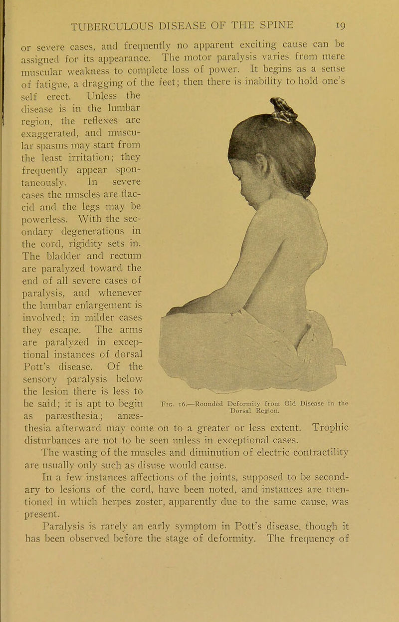 or severe cases, and frequently no apparent exciting cause can be assigned For its appearance. The motor paralysis varies from mere muscular w eakness to complete loss of power. It begins as a sense of fatigue, a dragging of the feet; then there is inability to hold one's self erect. Unless the disease is in the lumbar region, the reflexes are exaggerated, and muscu- lar spasms may start from the least irritation; they frequently appear spon- taneously. In severe cases the muscles are flac- cid and the legs may be powerless. With the sec- ondary degenerations in the cord, rigidity sets in. The bladder and rectum are paralyzed toward the end of all severe cases of paralysis, and whenever the lumbar enlargement is involved; in milder cases they escape. The arms are paralyzed in excep- tional instances of dorsal Pott's disease. Of the sensory paralysis below the lesion there is less to be said; it is apt to begin as paresthesia; anaes- thesia afterward may come on to a greater or less extent. Trophic disturbances are not to be seen unless in exceptional cases. The wasting of the muscles and diminution of electric contractility are usually only such as disuse would cause. In a few instances affections of the joints, supposed to be second- ary to lesions of the cord, have been noted, and instances are men- tioned in which herpes zoster, apparently due to the same cause, was present. Paralysis is rarely an early symptom in Pott's disease, though it has been observed before the stage of deformity. The frequency of Fig. 16, Rounded Deformity from Old Disease in the Dorsal Region.