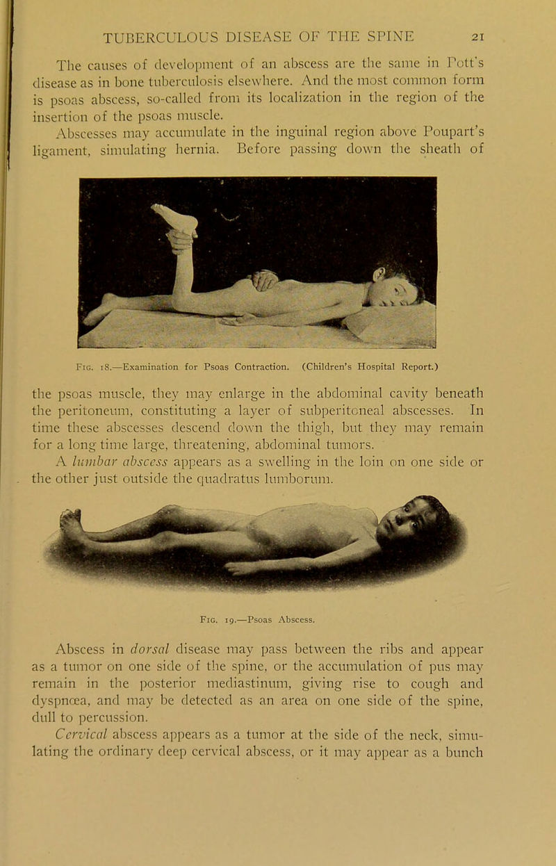 The causes of development of an abscess are the same in Pott's disease as in bone tuberculosis elsewhere. And the most common form is psoas abscess, so-called from its localization in the region of the insertion of the psoas muscle. Abscesses may accumulate in the inguinal region above Poupart's ligament, simulating hernia. Before passing down the sheath of the psoas muscle, they may enlarge in the abdominal cavity beneath the peritoneum, constituting a layer of subperitoneal abscesses. In time these abscesses descend down the thigh, but they may remain for a long time large, threatening, abdominal tumors. A lumbar abscess appears as a swelling in the loin on one side or the other just outside the quadratus lumborum. Abscess in dorsal disease may pass between the ribs and appear as a tumor on one side of the spine, or the accumulation of pus may remain in the posterior mediastinum, giving rise to cough and dyspnoea, and may be detected as an area on one side of the spine, dull to percussion. Cervical abscess appears as a tumor at the side of the neck, simu- lating the ordinary deep cervical abscess, or it may appear as a bunch Fig. i8.—Examination for Psoas Contraction. (Children's Hospital Report.) Fig. 19.—Psoas Abscess.