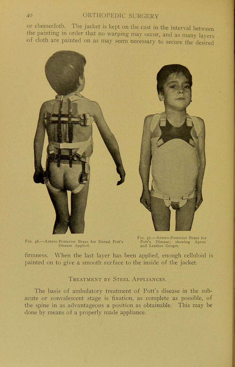 or cheesecloth. The jacket is kept on the cast in the interval between the painting in order that no warping may occur, and as many layers of cloth are painted on as may seem necessary to secure the desired Fig. 37.—Antero-Posterior Brace for Fig. 36.—Antero-Posterior Brace for Dorsal Pott's Pott's Disease; showing Apron Disease Applied. and Leather Gorget. firmness. When the last layer has been applied, enough celluloid is painted on to give a smooth surface to the inside of the jacket. Treatment by Steel Appliances. The basis of ambulatory treatment of Pott's disease in the sub- acute or convalescent stage is fixation, as complete as possible, of the spine in as advantageous a position as obtainable. This may be done by means of a properly made appliance.