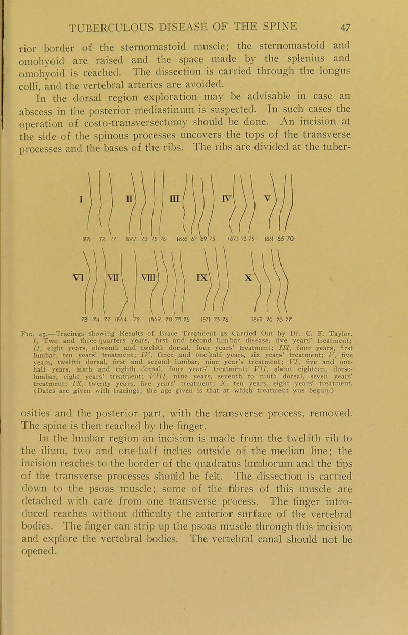 rior border of the sternomastoid muscle; the sternomastoid and omohyoid are raised and the space made by the splenitis and omohyoid is reached. The dissection is carried through the longus colli, and the vertebral arteries are avoided. In the dorsal region exploration may be advisable in case an abscess in the posterior mediastinum is suspected. In such cases the operation of costo-transversectomy should be done. An incision at the side of the spinous processes uncovers the tops of the transverse processes and the bases of the ribs. The ribs are divided at the tuber- Fig. 45.—Tracings showing Results of Brace Treatment as Carried Out by Dr. C. F. Taylor. I, Two and three-quarters years, first and second lumbar disease, five years' treatment; //, eight years, eleventh and twelfth dorsal, four years' treatment; III, four years, first lumbar, ten years' treatment; IV, three and one-half years, six years' treatment; V, five years, twelfth dorsal, first and second lumbar, nine year's treatment; VI, five and one- half years, sixth and eighth dorsal, four years' treatment; VII, about eighteen, dorso- lumbar, eight years' treatment; VIII, nine years, seventh to ninth dorsal, seven years' treatment; IX, twenty years, five years' treatment; X, ten years, eight years' treatment. (Dates are given with tracings; the age given is that at which treatment was begun.) osities and the posterior part, with the transverse process, removed. The spine is then reached by the finger. In the lumbar region an incision is made from the twelfth rib to the ilium, two and one-half inches outside of the median line; the incision reaches to the border of the quadratus lumborum and the tips of the transverse processes should be felt. The dissection is carried flown to the psoas muscle; some of the fibres of this muscle are detached with care from one transverse process. The finger intro- duced reaches without difficulty the anterior surface of the vertebral bodies. The finger can strip up the psoas muscle through this incision and explore the vertebral bodies. The vertebral canal should not be opened.