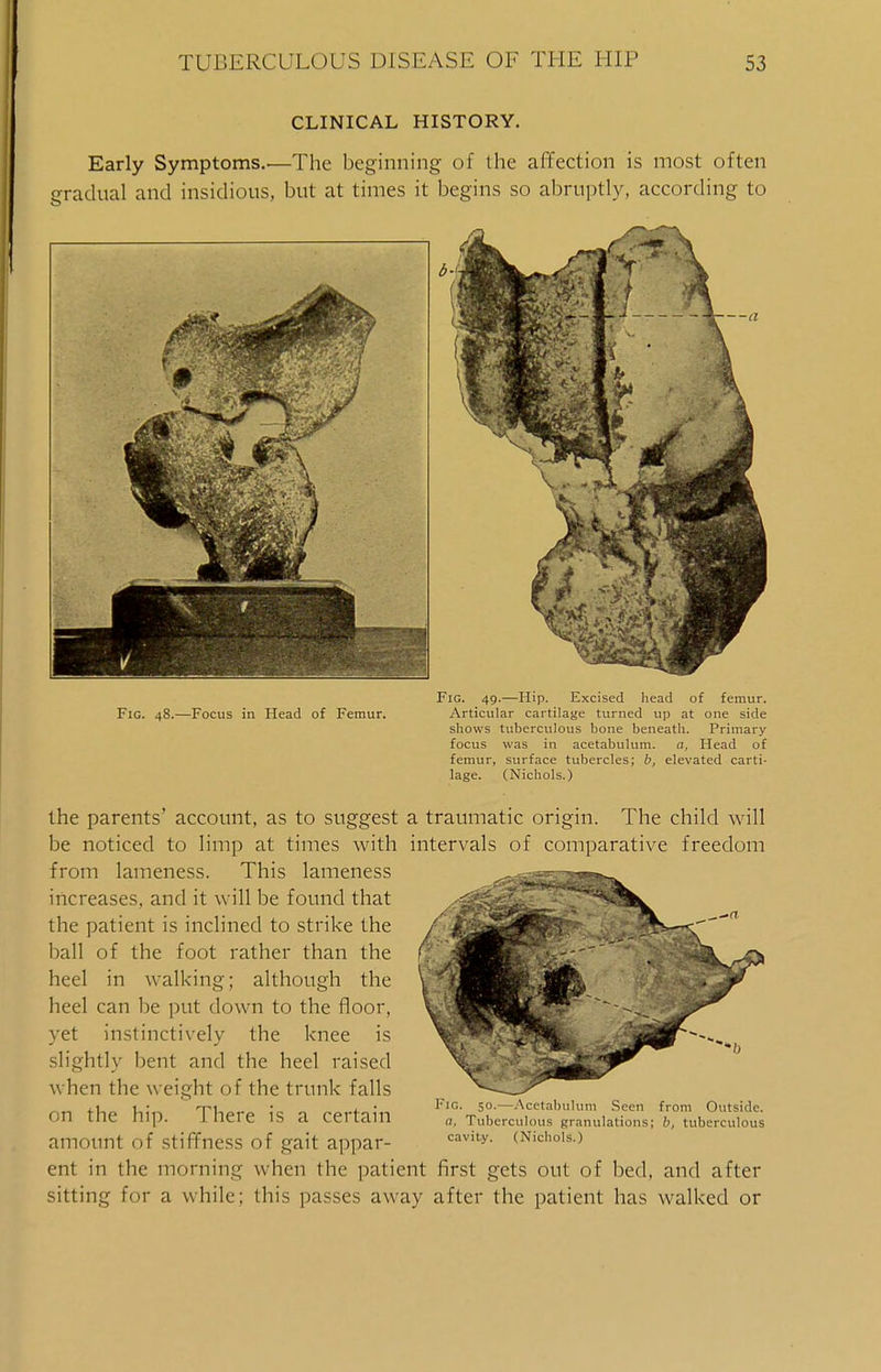 CLINICAL HISTORY. Early Symptoms..—The beginning of the affection is most often gradual and insidious, but at times it begins so abruptly, according to Fig. 49.—Hip. Excised head of femur. Fig. 48.—Focus in Head of Femur. Articular cartilage turned up at one side shows tuberculous bone beneath. Primary focus was in acetabulum. a, Head of femur, surface tubercles; b, elevated carti- lage. (Nichols.) the parents' account, as to suggest a traumatic origin. The child will be noticed to limp at times with intervals of comparative freedom from lameness. This lameness increases, and it will be found that the patient is inclined to strike the ball of the foot rather than the heel in walking; although the heel can be put down to the floor, yet instinctively the knee is slightly bent and the heel raised when the weight of the trunk falls on the hip. There is a certain amount of stiffness of gait appar- ent in the morning when the patient first gets out of bed, and after sitting for a while; this passes away after the patient has walked or Fig. 50.—Acetabulum Seen from Outside. a. Tuberculous granulations; b, tuberculous cavity. (Nichols.)