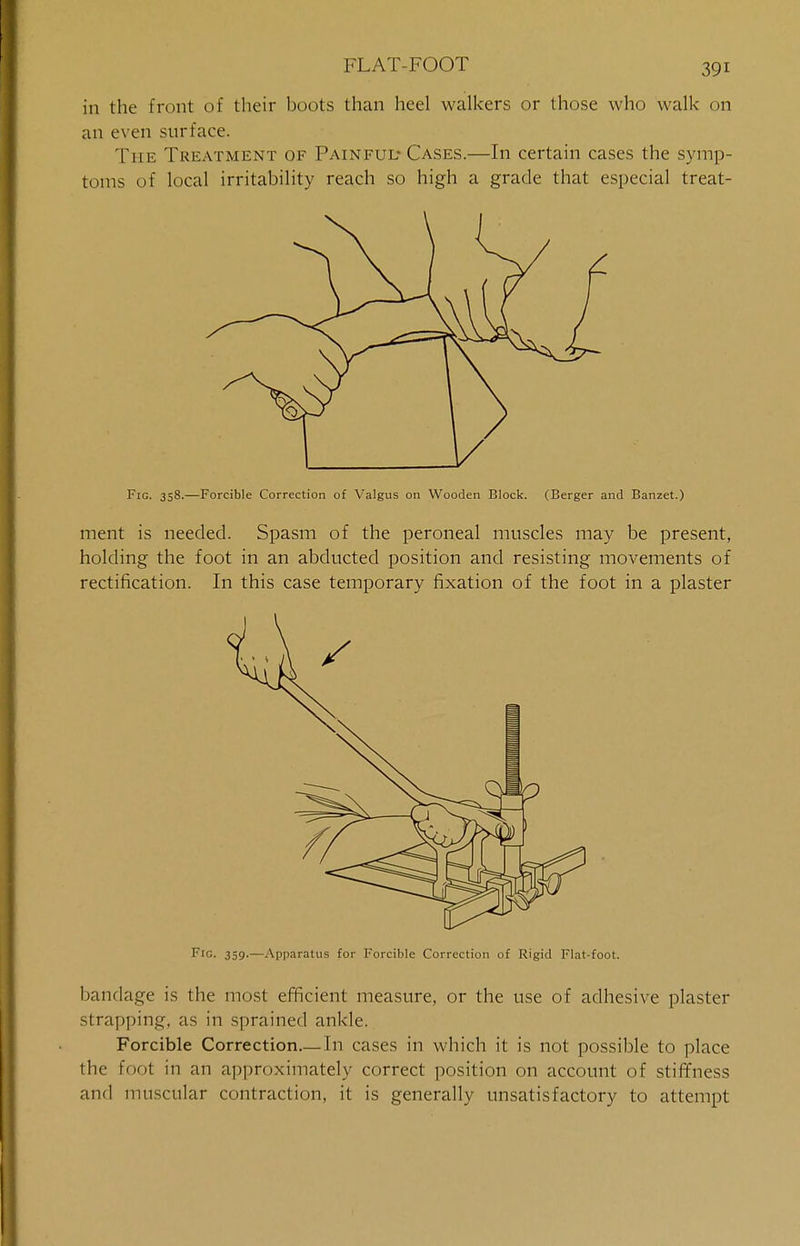 in the front of their hoots than heel walkers or those who walk on an even surface. The Treatment of Painful-Cases.—In certain cases the symp- toms of local irritability reach so high a grade that especial treat- Fig. 358.—Forcible Correction of Valgus on Wooden Block. (Berger and Banzet.) ment is needed. Spasm of the peroneal muscles may be present, holding the foot in an abducted position and resisting movements of rectification. In this case temporary fixation of the foot in a plaster FlG. 359.—Apparatus for Forcible Correction of Rigid Flat-foot. bandage is the most efficient measure, or the use of adhesive plaster strapping, as in sprained ankle. Forcible Correction.—In cases in which it is not possible to place the foot in an approximately correct position on account of stiffness and muscular contraction, it is generally unsatisfactory to attempt