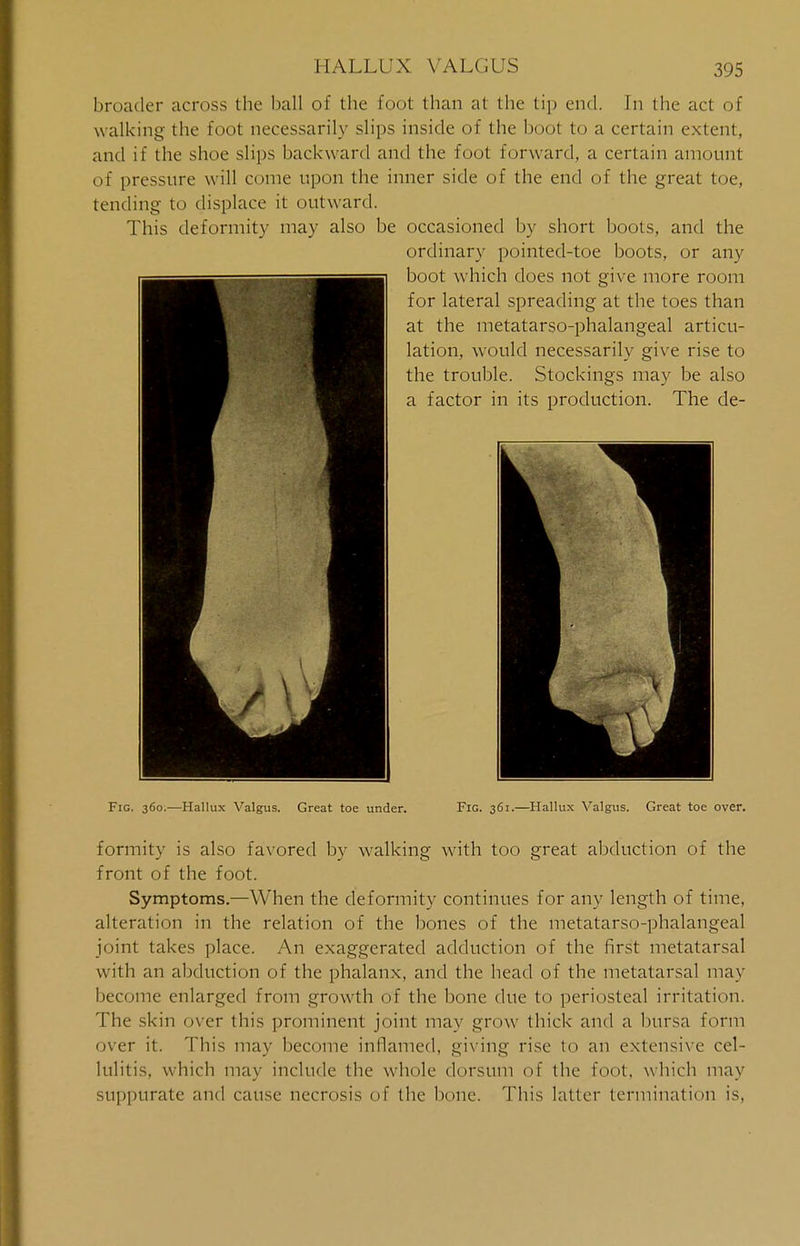 HALLUX VALGUS broader across the ball of the foot than at the tip end. In the act of walking the foot necessarily slips inside of the boot to a certain extent, and if the shoe slips backward and the foot forward, a certain amount of pressure will come upon the inner side of the end of the great toe, tending to displace it outward. This deformity may also be occasioned by short boots, and the ordinary pointed-toe boots, or any boot which does not give more room for lateral spreading at the toes than at the metatarsophalangeal articu- lation, would necessarily give rise to the trouble. Stockings may be also a factor in its production. The de- Fig. 360.—Hallux Valgus. Great toe under. Fig. 361.—Hallux Valgus. Great toe over. formity is also favored by walking with too great abduction of the front of the foot. Symptoms.—When the deformity continues for any length of time, alteration in the relation of the bones of the metatarso-phalangeal joint takes place. An exaggerated adduction of the first metatarsal with an abduction of the phalanx, and the head of the metatarsal may become enlarged from growth of the bone due to periosteal irritation. The skin over this prominent joint may grow thick and a bursa form over it. This may become inflamed, giving rise to an extensive cel- lulitis, which may include the whole dorsum of the foot, which may suppurate and cause necrosis of the bone. This latter termination is,