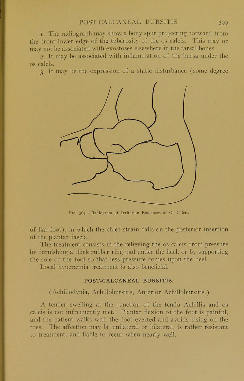 [. The radiograph may show a bony spur projecting forward from the front lower edge of the tuberosity of the os calcis. This may or may not be associated with exostoses elsewhere in the tarsal bones. _>. It may be associated with inflammation of the bursa under the os calcis. 3. It may be the expression of a static disturbance (some degree Fig. 364.—Radiogram of Irritation Exostoses of Os Calcis. of flat-foot), in which the chief strain falls on the posterior insertion of the plantar fascia. The treatment consists in the relieving the os calcis from pressure by furnishing a thick rubber ring pad under the heel, or by supporting the sole of the foot so that less pressure comes upon the heel. Local hyperemia treatment is also beneficial. POST-CALCANEAL BURSITIS. (Achillodynia, Achillobursitis, Anterior Achillobursitis.) A tender swelling at the junction of the tendo Achillis and os calcis is not infrequently met. Plantar flexion of the foot is painful, and the patient walks with the foot everted and avoids rising on the toes. The affection may be unilateral or bilateral, is rather resistant to treatment, and liable to recur when nearly well.