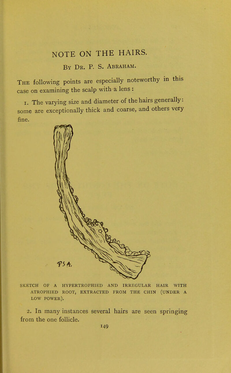 NOTE ON THE HAIRS. By Dr. P. S. Abraham. The following points are especially noteworthy in this case on examining the scalp with a lens : I. The varying size and diameter of the hairs generally: some are exceptionally thick and coarse, and others very fine. SKETCH OF A HYPERTROPHIED AND IRREGULAR HAIR WITH ATROPHIED ROOT, EXTRACTED FROM THE CHIN (UNDER A LOW POWER). 2. In many instances several hairs are seen springing from the one follicle.