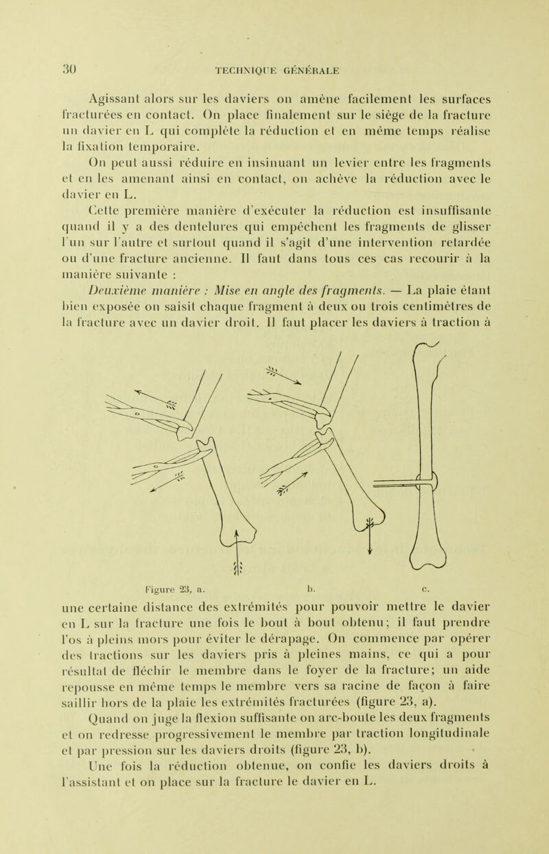 Agissant alors siir les daviers on amene facilement les surfaces IVactuiees en contact. On place finalcment sur le siege de la fracture un davier en L qui complete la reduction el en meme temps realise la fixation temporaire. On pent aussi reduire en insinuant un levier entre les fragments et en les amenant ainsi en contact, on achevc la reduction avec le davier en L, Cette premiere maniere d'executer la reduction est insuffisante quand il y a des dentelures qui empechent les fragments de glisser Tun sur I'autre et surlout quand il s'agit d'une intervention retardee ou d'une fracture ancienne. II faut dans tons ces cas recourir a la maniere suivante : Dcuxieme maniere : Mise en angle den fragments. — La plaie etant l)ien exposee on saisit cliaque fragment a deux ou ti'ois centimetres de la I'racture avec un davier droit. II faut placer les daviei s a traction a Figure 23, a. b. c. une certaine distance des extremites pour pouvoir mettre le davier en L sur la fracture une fois le bout a bout obtenu; il faut prendre I'os a pleins mors pour eviter le derapage. On commence par operer des tractions sur les daviers pris a pleines mains, ce qui a pour resultat de flecliir le membre dans le foyer de la fracture; un aide repousse en meme tem})s le membre vers sa racine de facon a faire saillir hors de la plaie les extremites fracturees (figure 23, a). Quand on juge la tlexion suftisante on arc-boute les deux fragments et on redresse progressivement le membre par traction longitudinale et par pression sur les daviers droits (figure 23, b). Une fois la reduction obtenue, on confie les daviers droits a I'assistant et on place sur la fracture le davier en L.