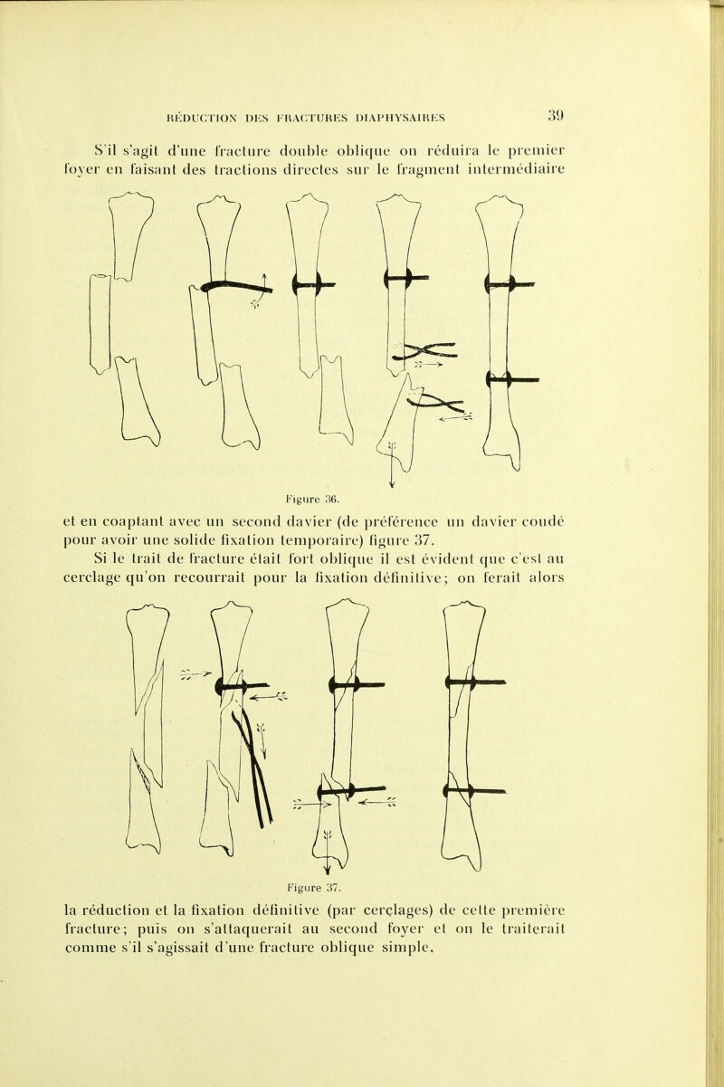 S'il s'agit d'une fracture double oblique ou reduira le premier foyer en faisant des tractions directes sur le fragment intermediaire V Figure 36. et en coaptant avec un second davier (de preference un davier coude pour avoir une solide tixation temporaire) figure 37. Si le trait de fracture etait fort oblique il est evident que c'esl au cerclage qu'on recourrait pour la fixation definitive; on ferait alors Figure 37. la reduction et la fixation definitive (par cerclages) de cette piemiere fracture; puis ou s'attaquerait au second foyer et on le traiterail comnie s il s'agissait d'une fracture oblique simple.